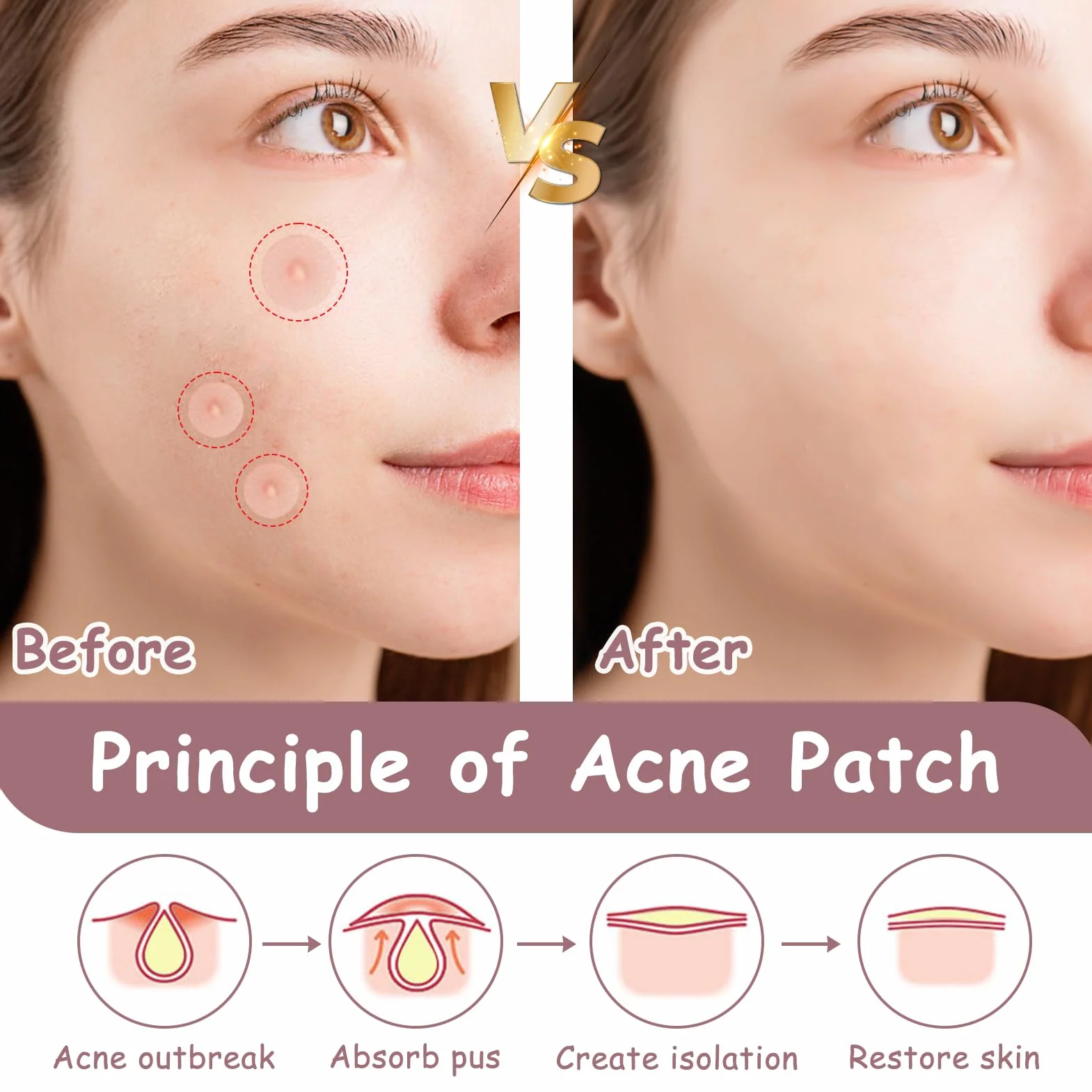 360 Piezas Parches para Acné Hidrocoloides, Parches para Granos Día y Noche, Pimple Patch Parches Anti Acne Impermeables Transpirables, Absorbe el Pus Reduce Cicatrices, Todo Tipo de Piel 10mm/12mm