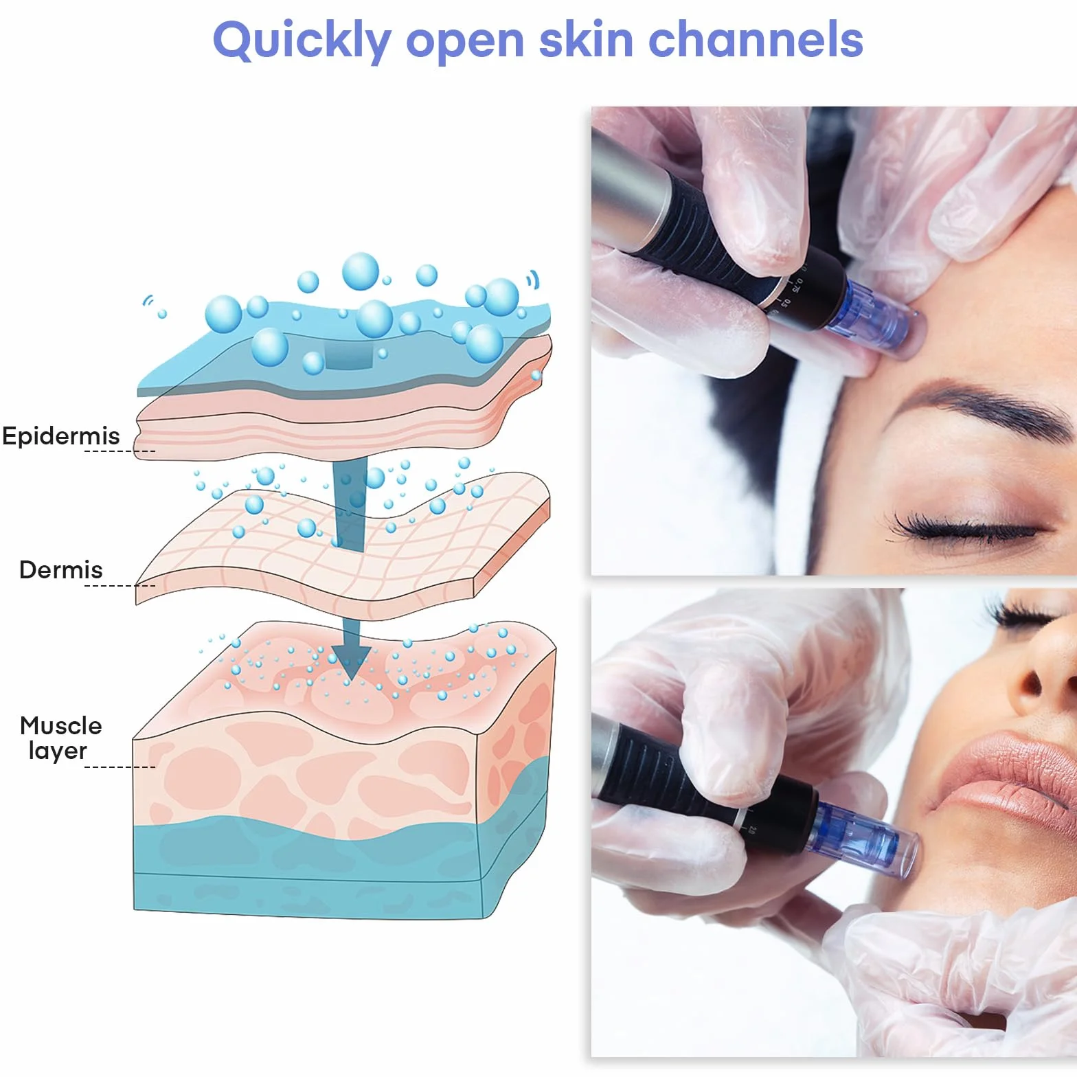 Agujas Dermapen 36 puntas Cartuchos Microneedling para Derma Pen ULTIMA A6 A10 M5 M7 Ranura Bayoneta