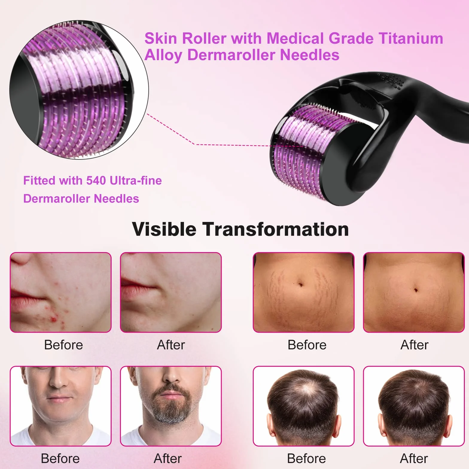 Derma Roller 0,5 mm 540 microagujas de titanio para cara barba cicatrices Rodillo facial