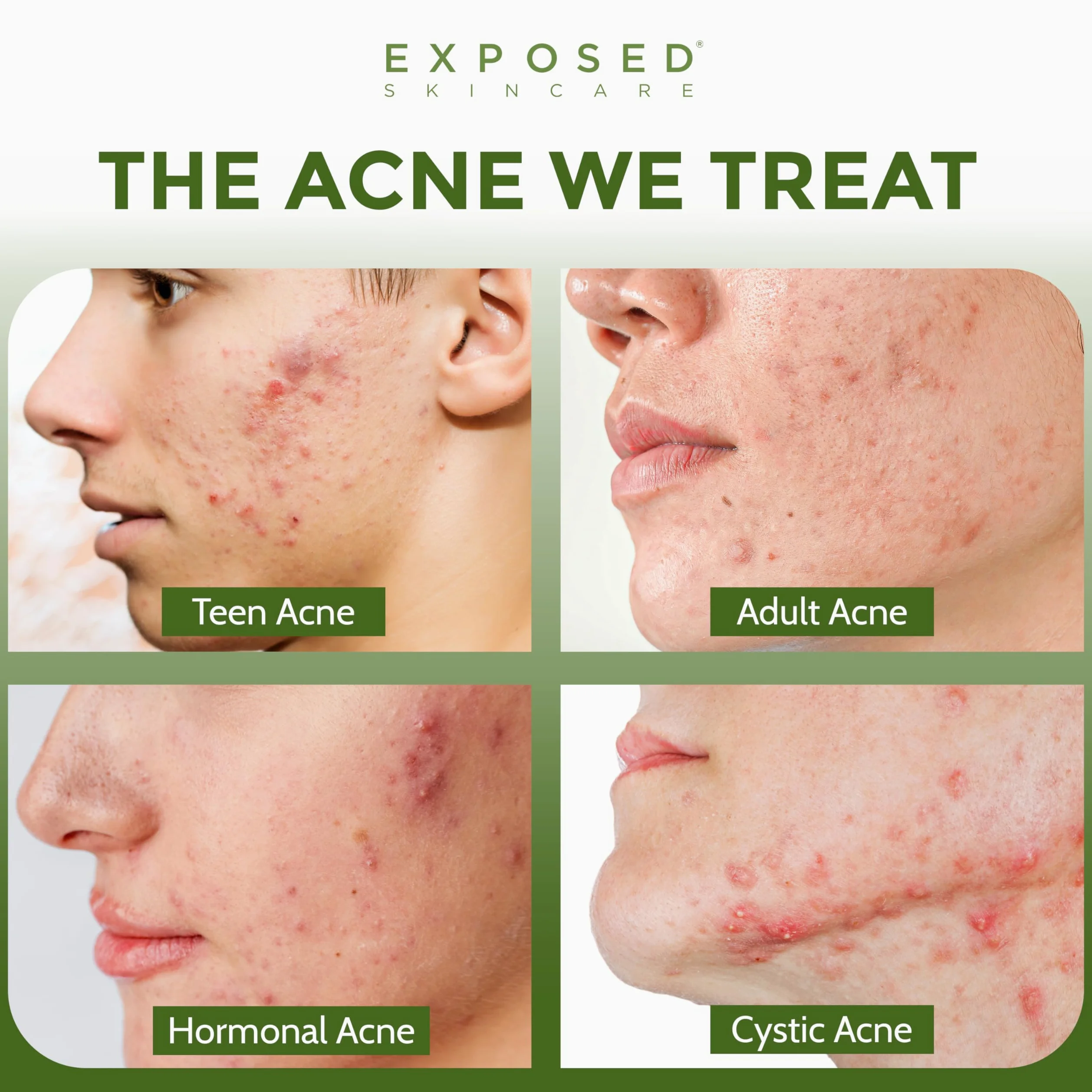 Exposed Skin Care Kit de tratamiento para el acné - Solución natural para el acné para el rostro, todos los tipos de piel y edades - Contiene detergente, tónico, suero, suero limpiador de poros