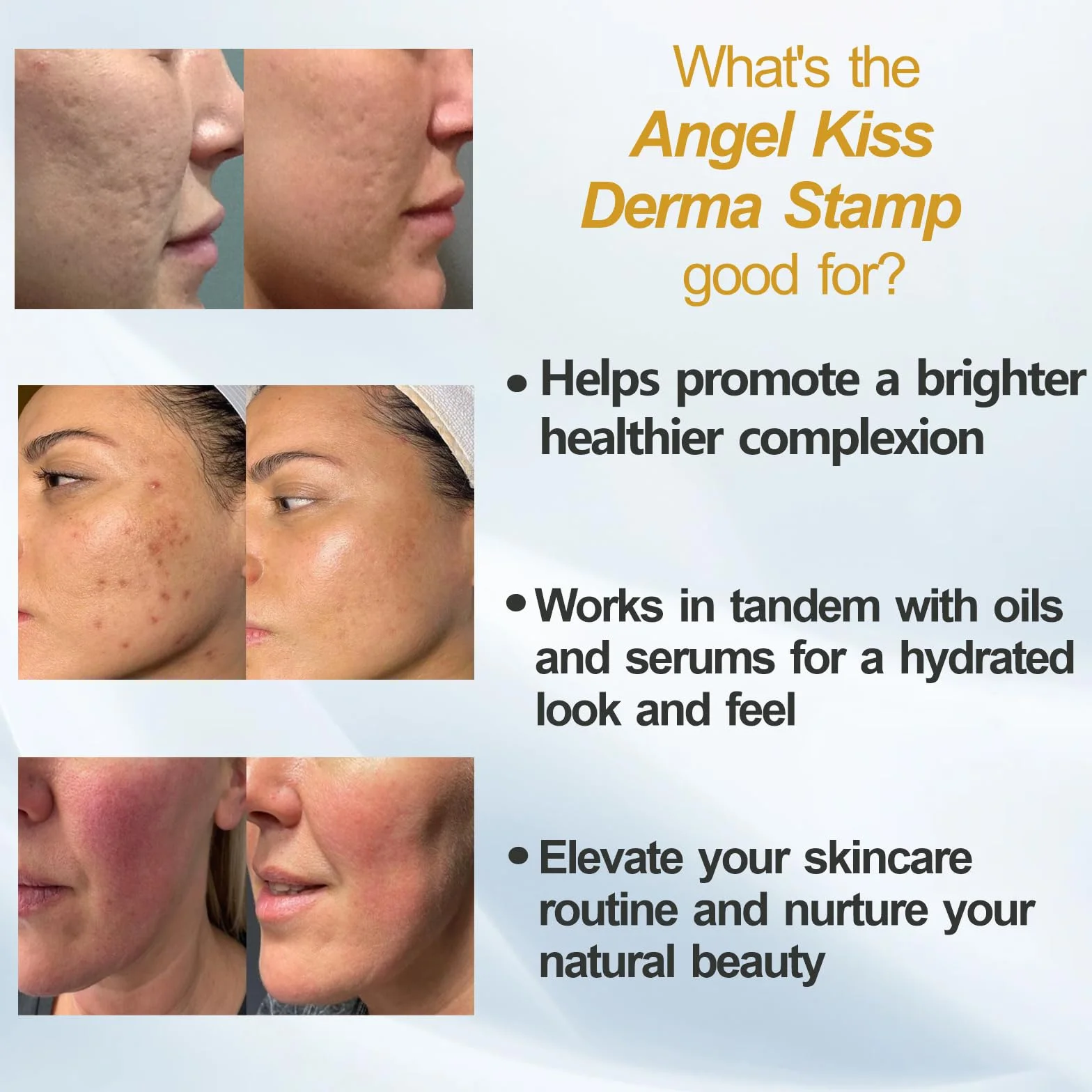 Angel Kiss Sello de Microagujas Derma Roller Stamp Profesional 120 Agujas Titanio Ajustable 0-2.0 mm