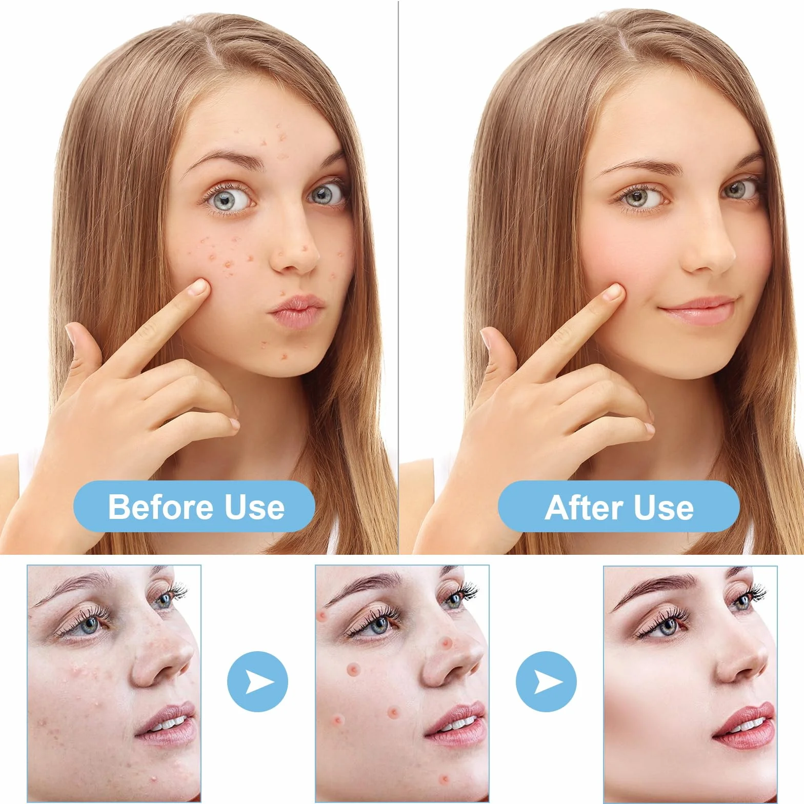 Parches Granos 240 Piezas Pimple Patches con Aceite del árbol del Té Diurno y Nocturno Acne Patch Invisibles