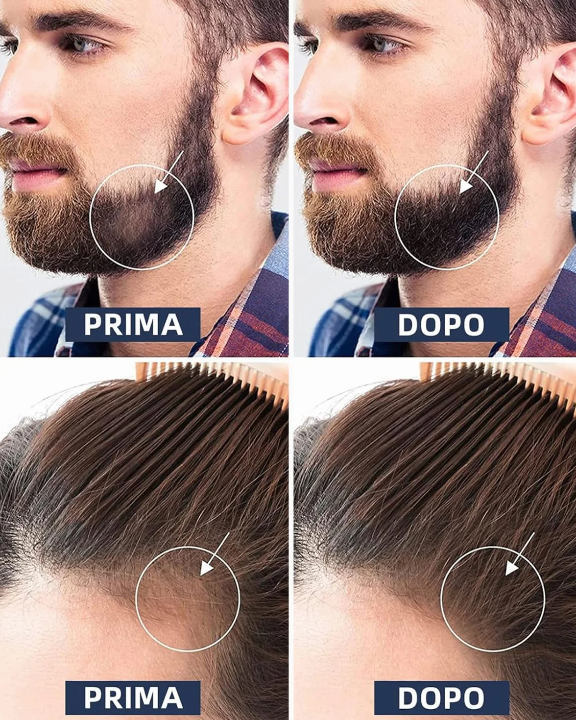 Rodillo de microagujas 0,5 mm 540 agujas de titanio para crecimiento de barba y cabello