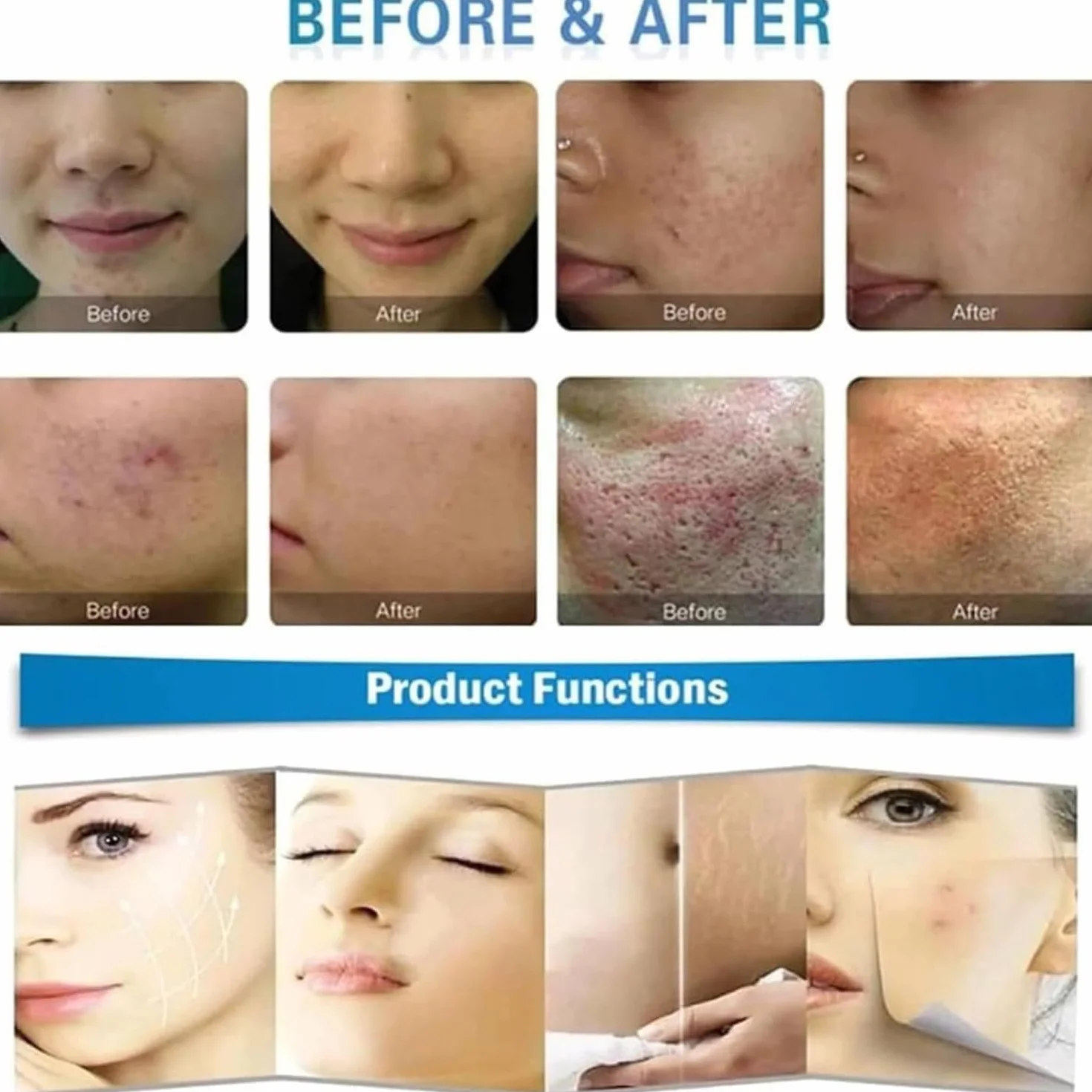 Dispositivo Avanzado de Belleza con 4 Cabezales Especializados: Combina Microagujas y RF para Tratamientos Faciales y Corporales de Rejuvenecimiento y Reparación Cutánea