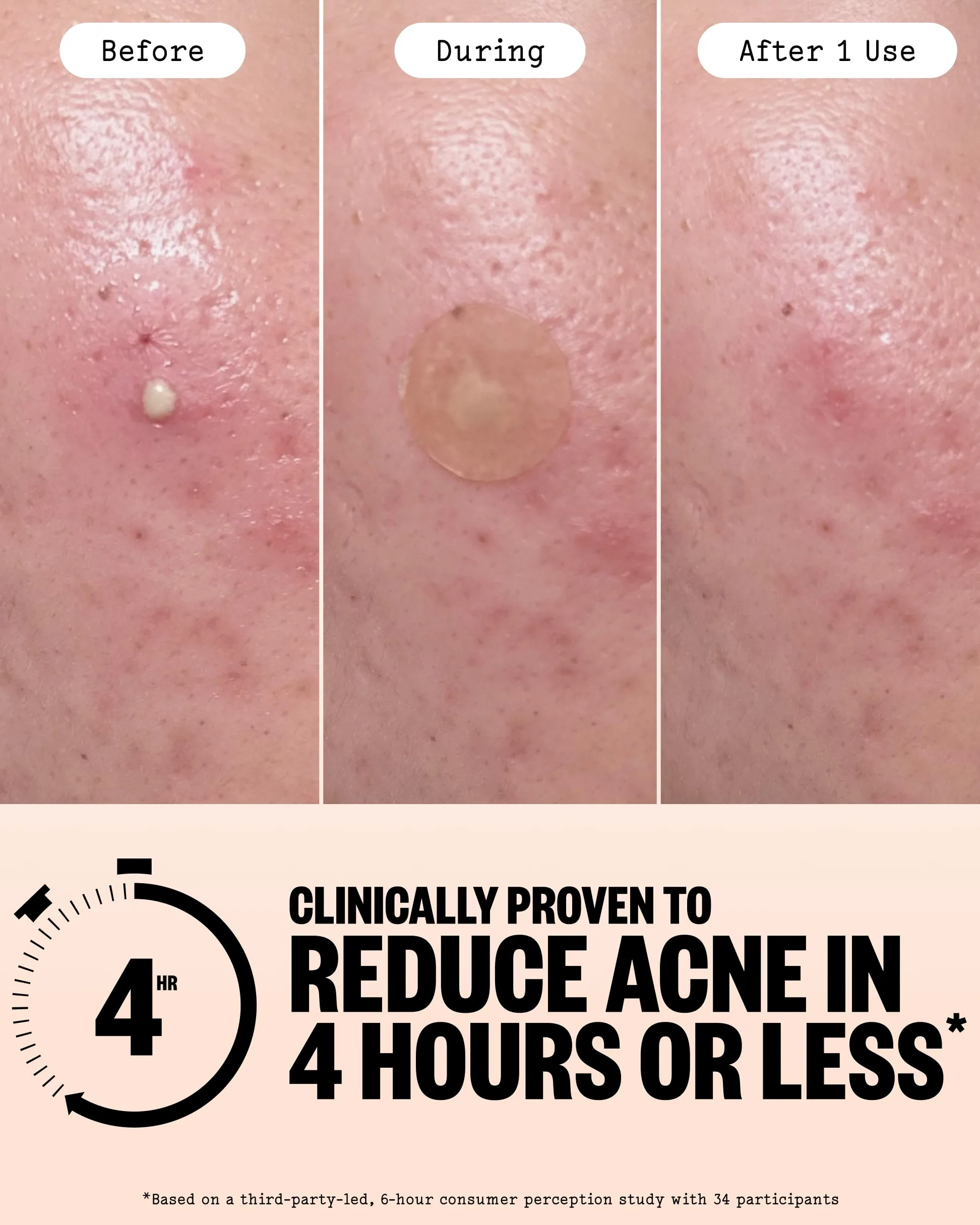 PEACE OUT Parches hidrocoloides para curar el acné, tratamiento de manchas de acné con ácido salicílico, retinol y aloe vera para imperfecciones y brotes (40 unidades)