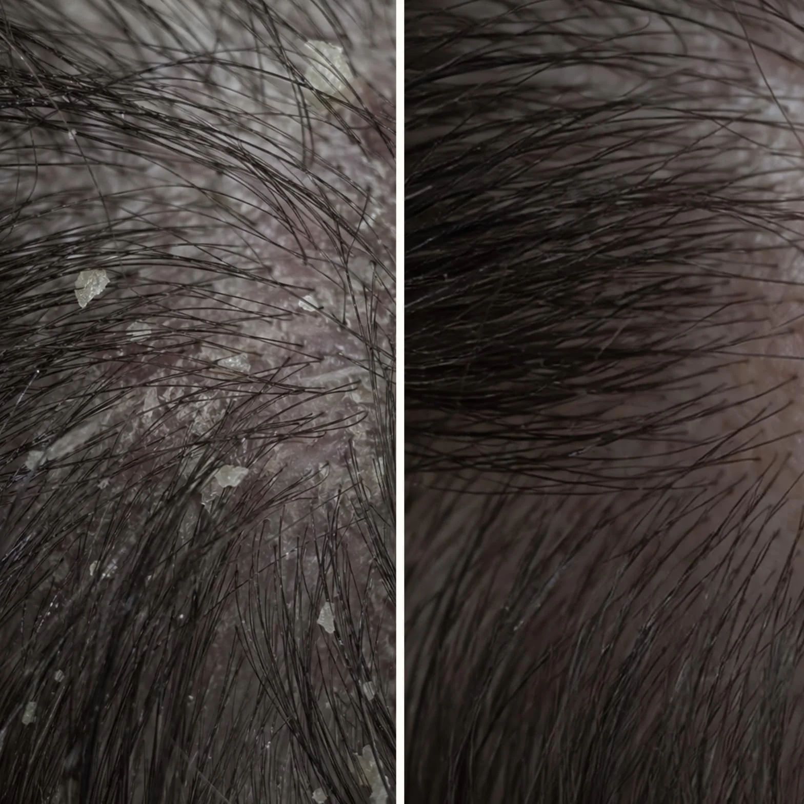 Peeling Cuero Cabelludo Ácido Salicílico Caspa Picazón Sequedad Tratamiento Pre-Lavado 10 Minutos Exfolia Limpieza Profunda Piroctone Olamine 150 ml