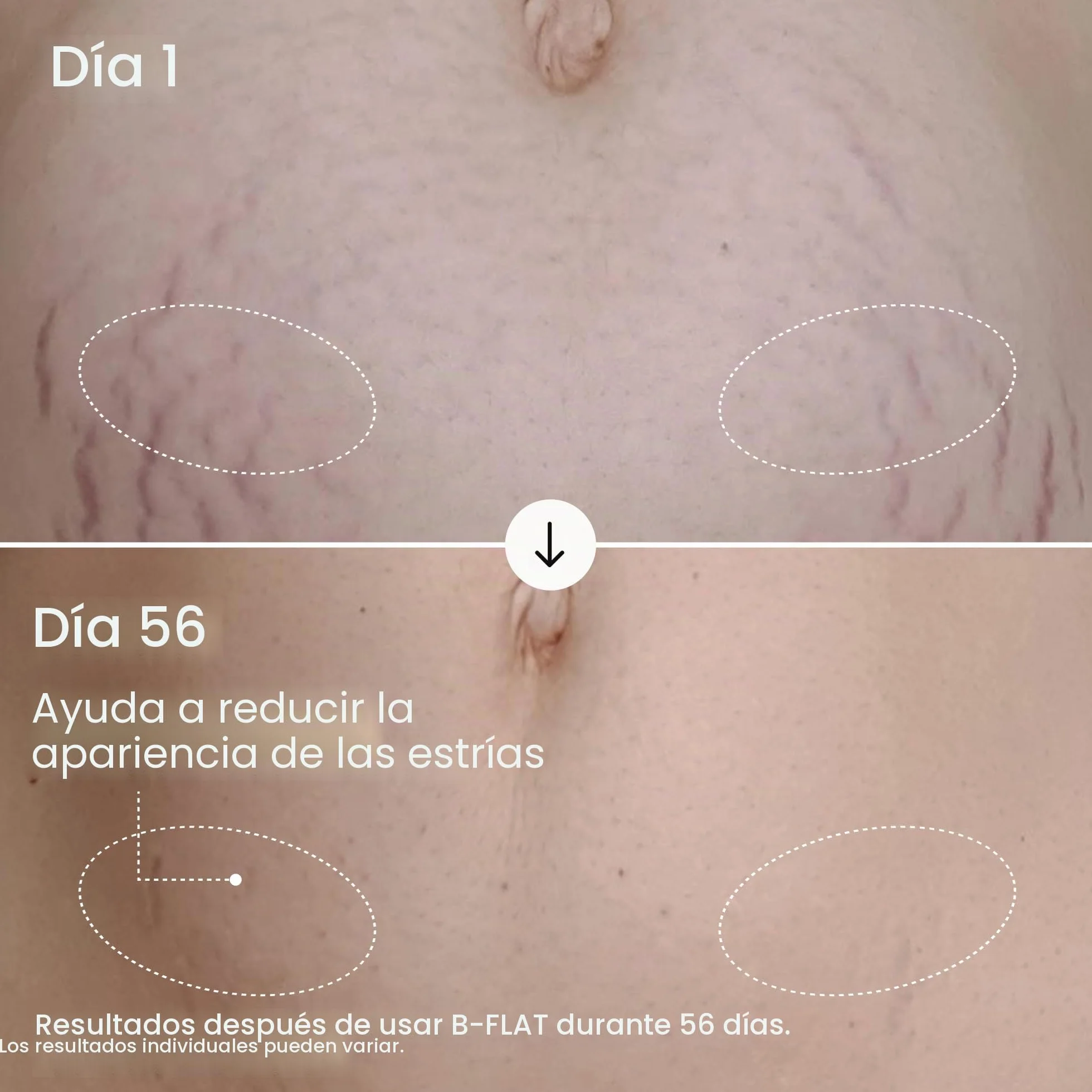 B-Flat Cellulite Stretch Marks Firming Cream | Belly Skin Treatment | Anti-Cellulite Stomach Lotion with Arabica Coffee & Hyaluronic Acid.