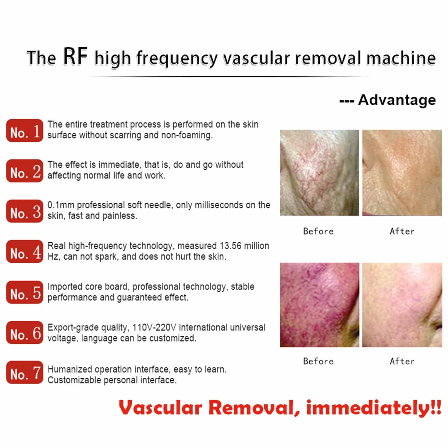 Dispositivo de eliminación de arañas vasculares de Alta frecuencia, máquina de Belleza para Eliminar Venas de Hilo Facial, Manchas de Vasos sanguíneos Rojos, para piernas, Cara, Nariz, para Mujeres