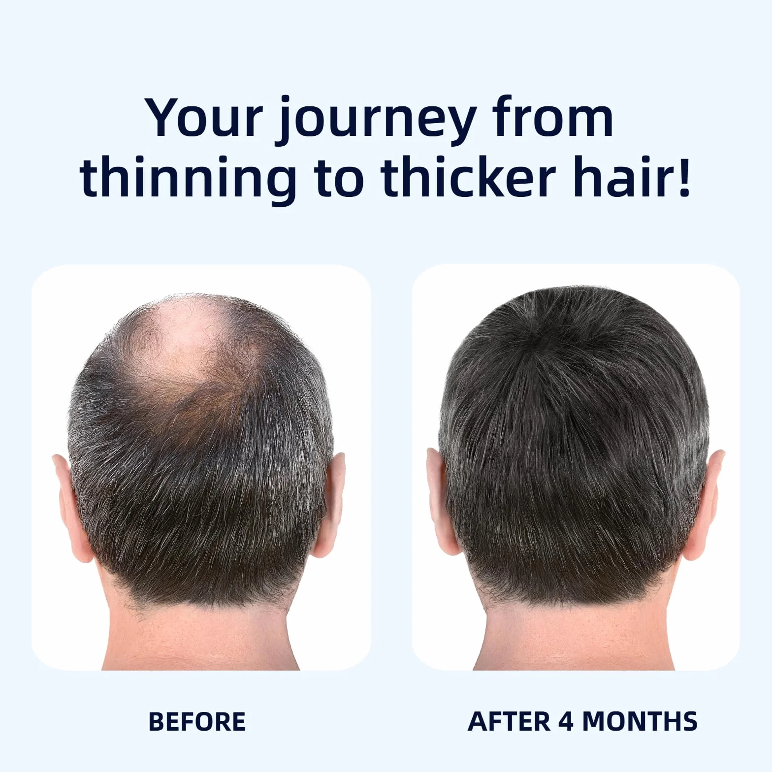 Serum Capilar Anticaída 2 x 50 ml, Hair Growth Serum con Biotina, Densificador Capilar Ligero para Hombre y Mujer, Serum Capilar Fortificante para Cabello Fino, Débil y Dañado, Azul
