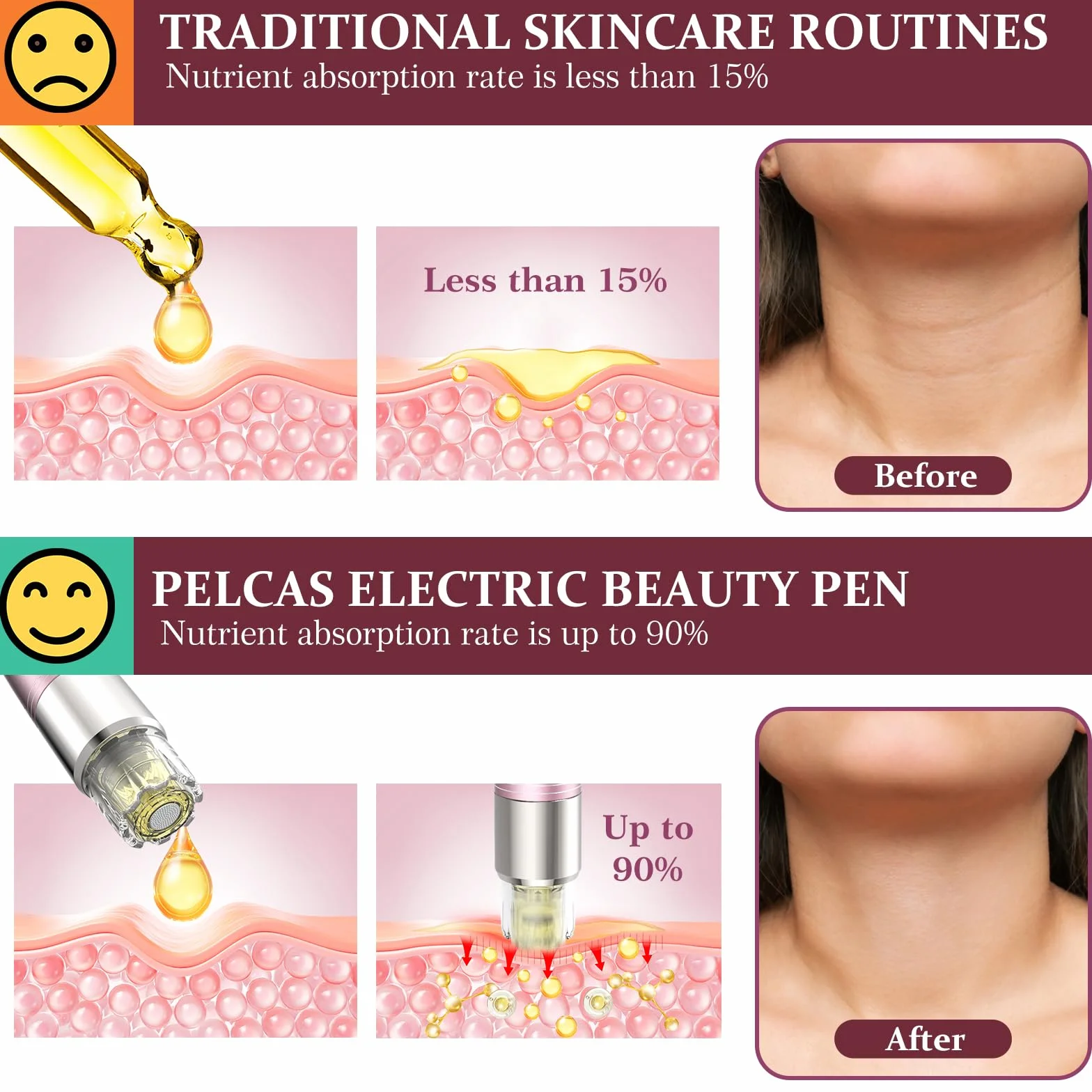 PELCAS Dermapen Aplicador Automático de Suero 5 Niveles Profesional con 6 Cartuchos Oro Rosa