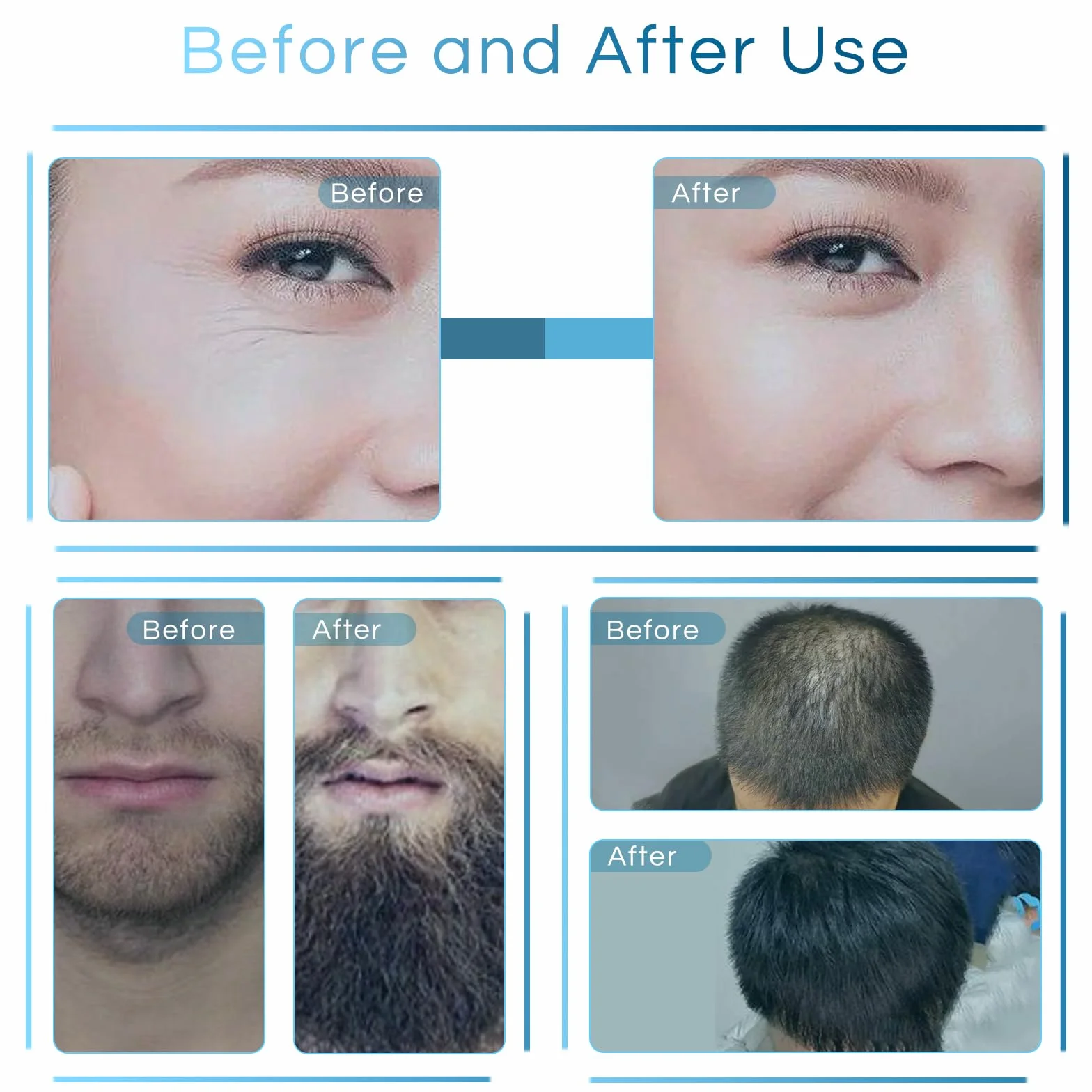 Derma Stamp 0 a 3mm Ajustable para Crecimiento del Cabello y Barba, Microneedling Profesional