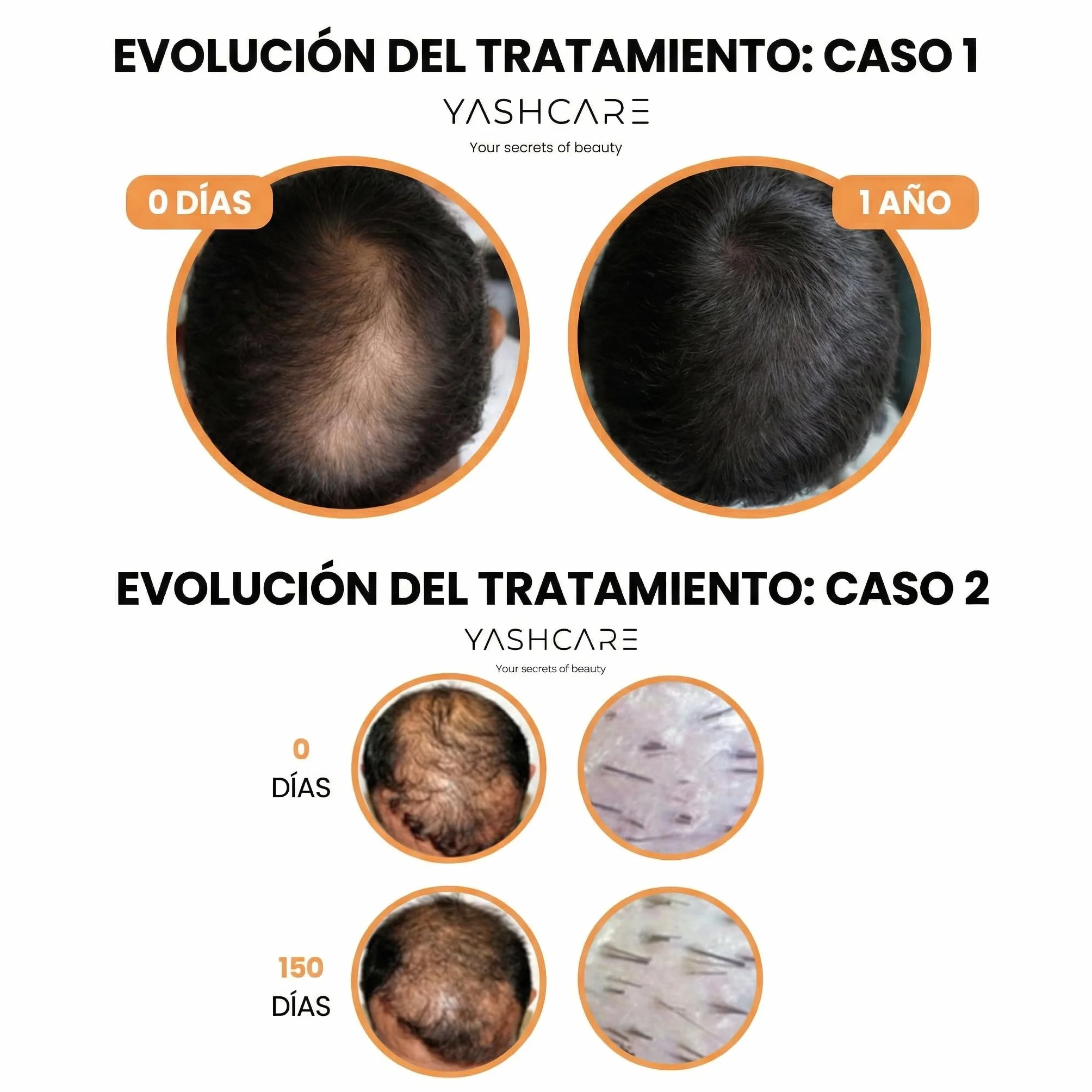 Serum Anticaida con Biotina para el Cabello 100 ml - Reduce Caída y Estimula Crecimiento