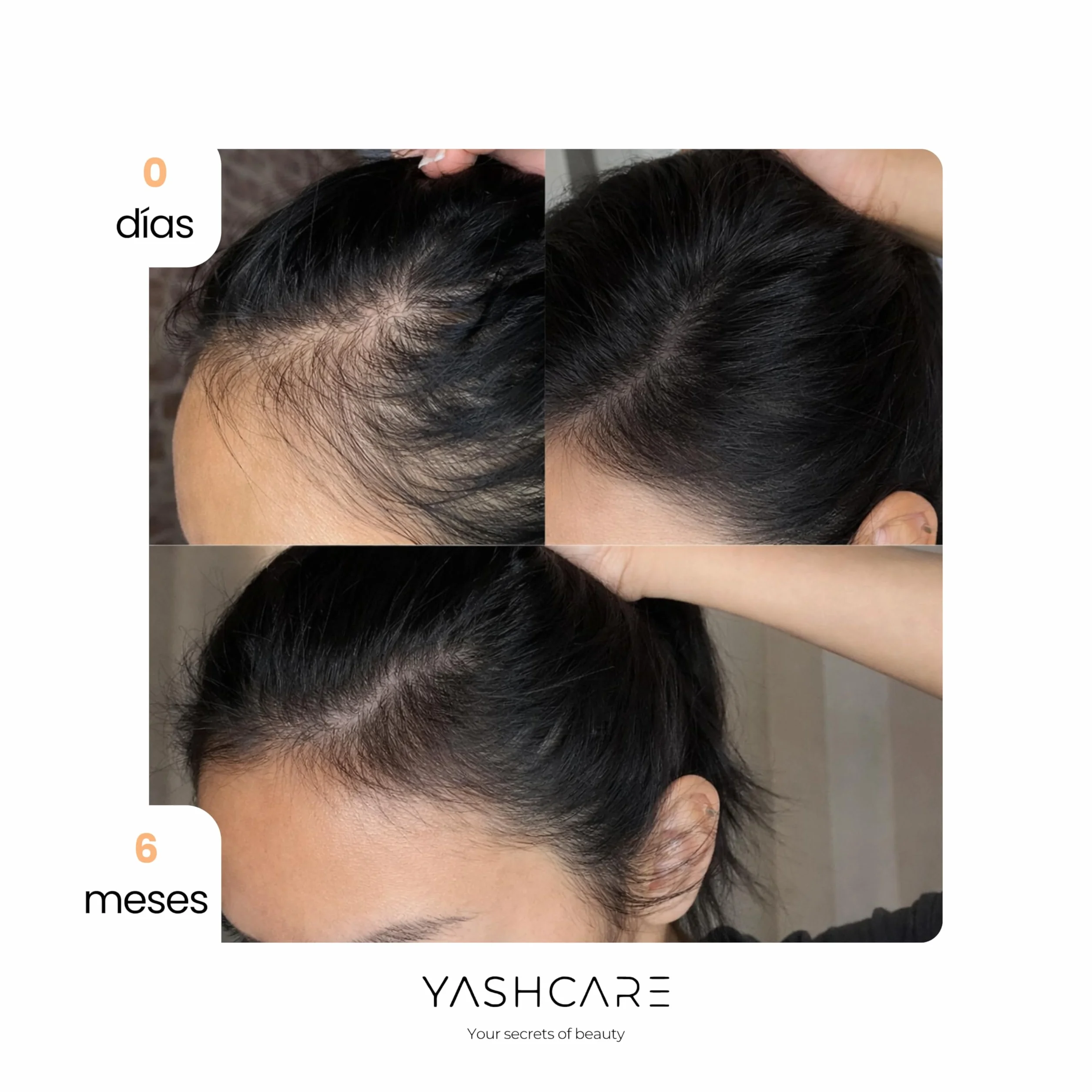 Serum Anticaida con Biotina para el Cabello 100 ml - Reduce Caída y Estimula Crecimiento