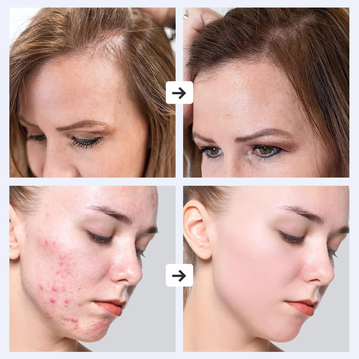 GESS Dars Dispositivo Alta Frecuencia 5 en 1 para Cabello y Rostro, Máquina con 5 Electrodos Neón y Argón Darsonval