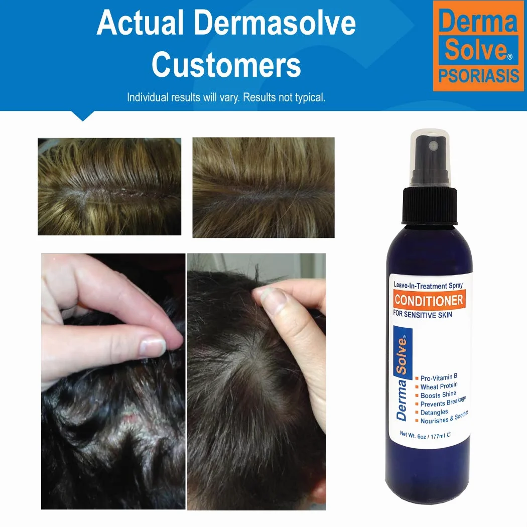 Dermasolve Psoriasis Leave-In-Treatment & Styling Spray Bálsamo para Dermatitis Seborreica, Piel Sensible, Desenredante, Desenredar, Calmante Anticaspa, Reparación del cuero cabelludo seco