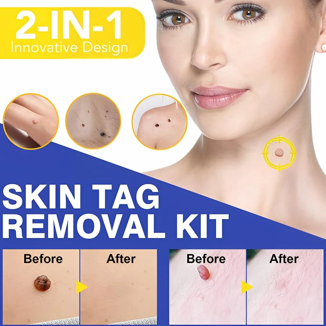 Skin Tag Remover Set para Eliminar Verrugas y Lunares Eficaz e Indoloro