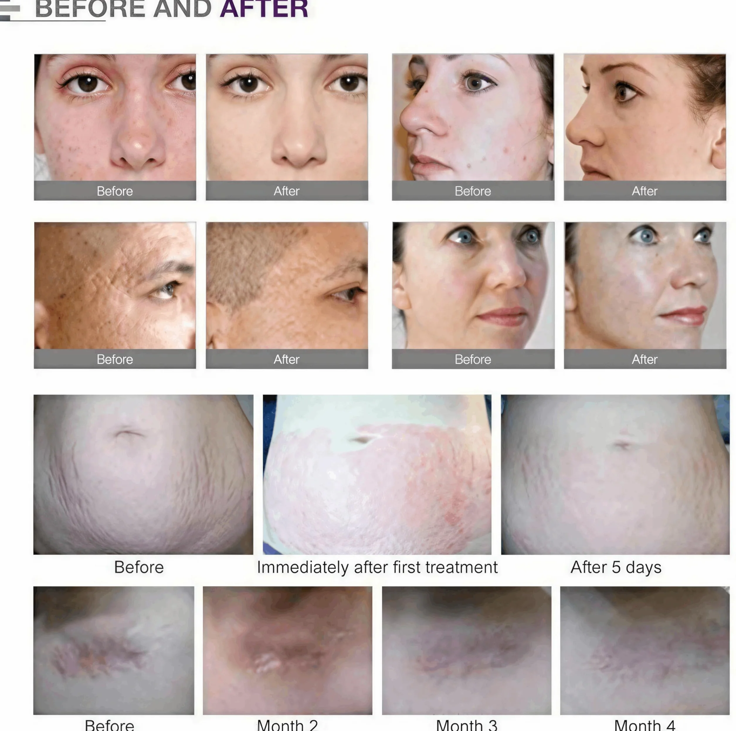 36 Pin Micro Needles Dermapen Cartucho Repuesto Bajonett Port Puntas Ranura 10 Piezas