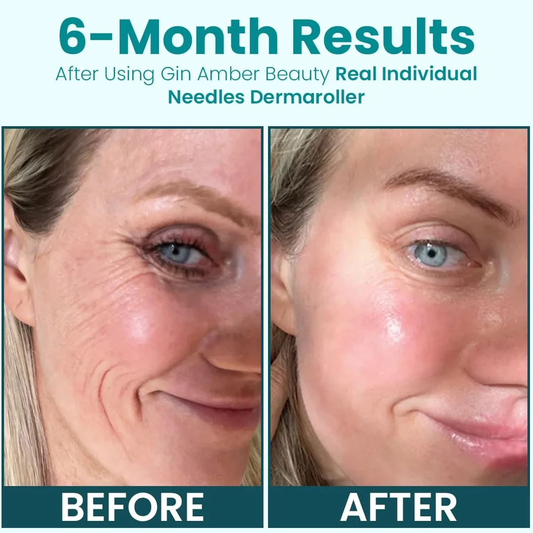 Gin Amber Beauty Derma Roller (0,25 mm) - 192 agujas individuales reales, dispositivo de microdermoabrasión para el cuidado de la piel, absorción de suero con microagujas, herramienta revitalizadora