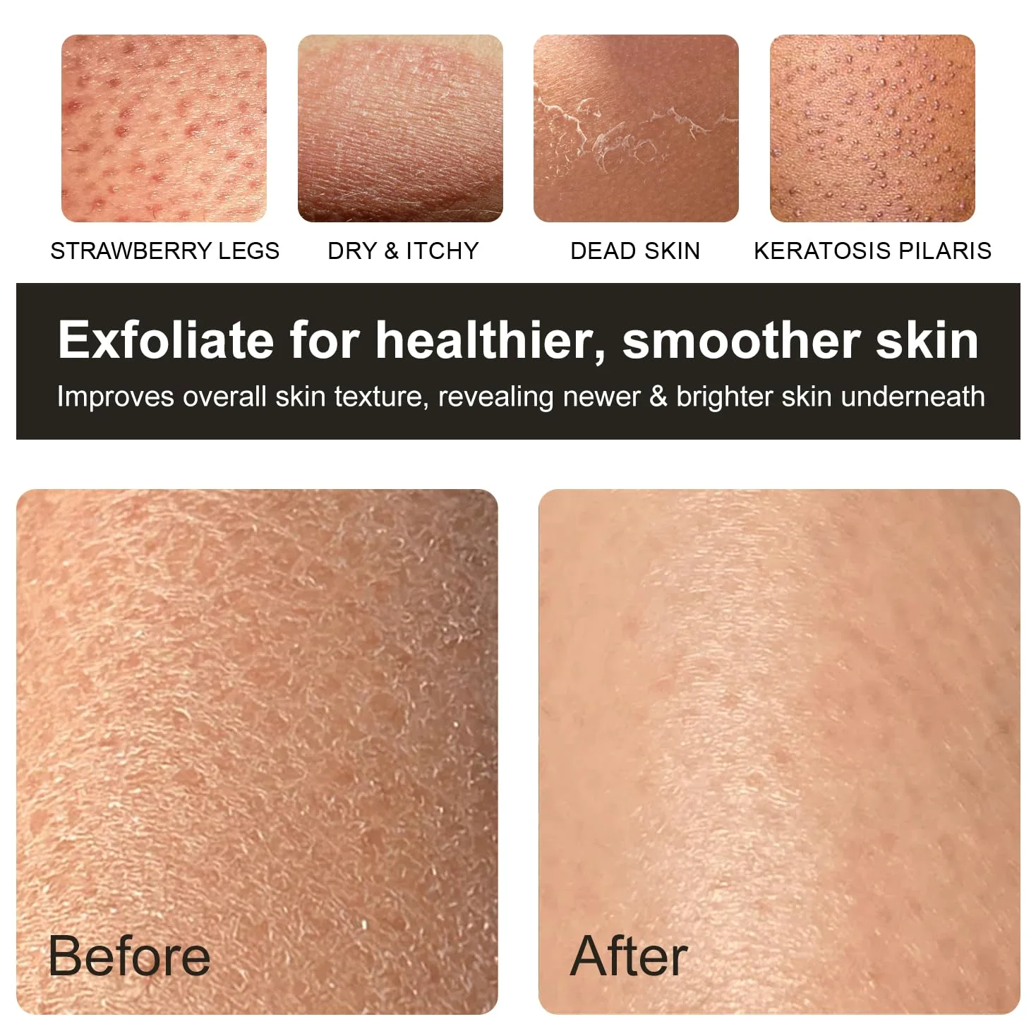 Guante exfoliante profundo, guante exfoliante para ducha, removedor de piel muerta y exfoliante de piel para cuerpo, guante exfoliante corporal para queratosis pilaris, guante de exfoliación corporal,
