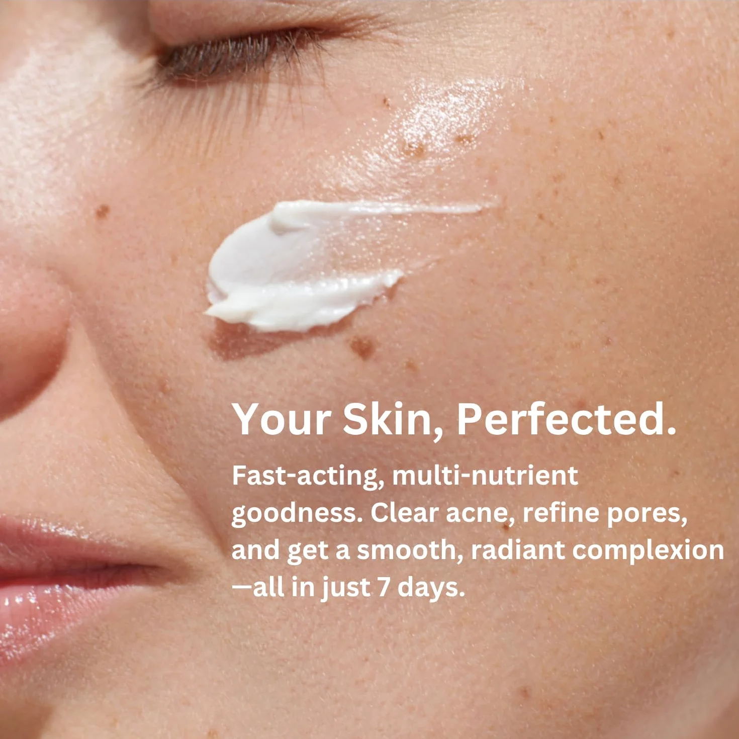 Crema Antiacné PREMIADA - ¡4X MÁS POTENTE y 11X MÁS RÁPIDA! Tecnología patentada con Ácido Salicílico Orgánico, Avellano de Bruja, Vitamina A, Aceite de Árbol de Té y Aloe Vera. Combate Granos - 100ml