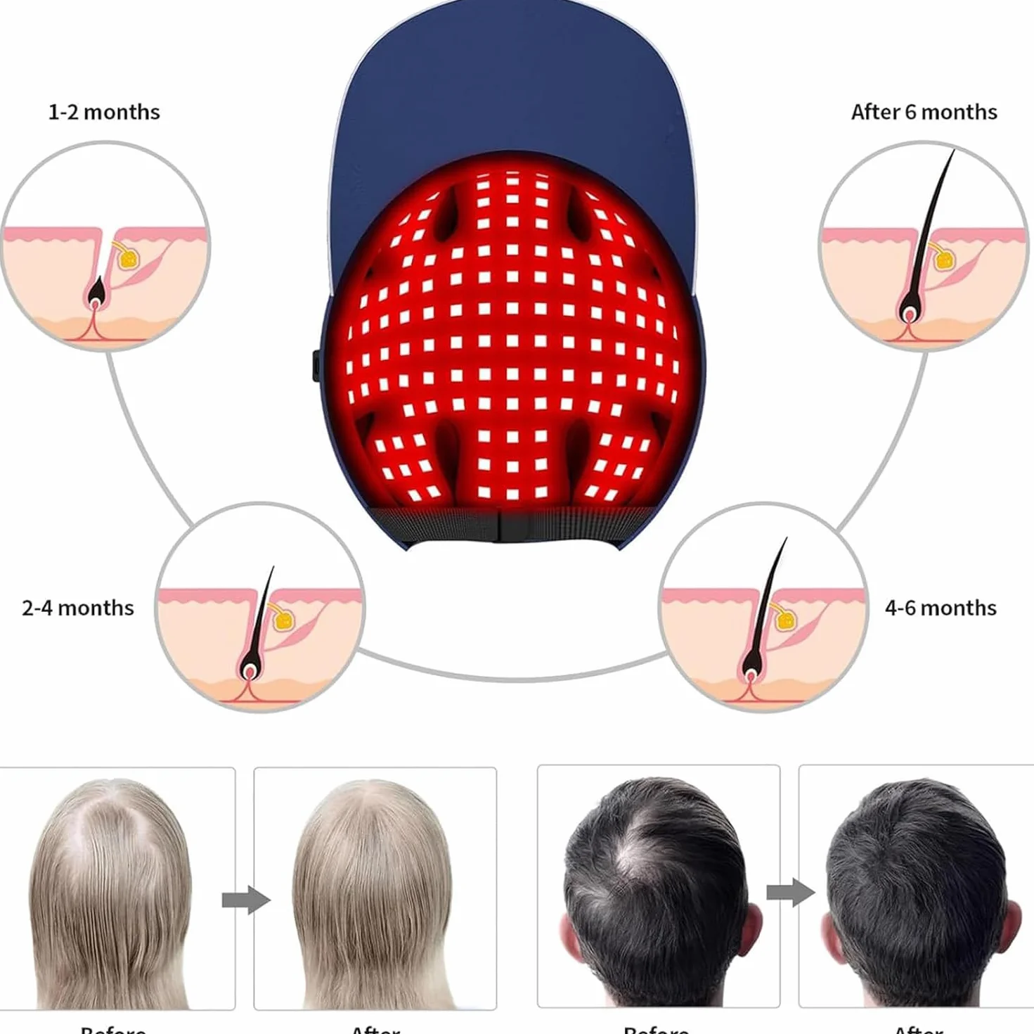 Gorro De Terapia De Luz Roja, 160 Piezas De Cuentas De Lámpara, Gorro De Crecimiento Del Cabello Con Control De Aceite, Longitud De Onda 630 Nm, 850 Nm Y 940 Nm, Gorro De Crecimiento Del Cabello LED