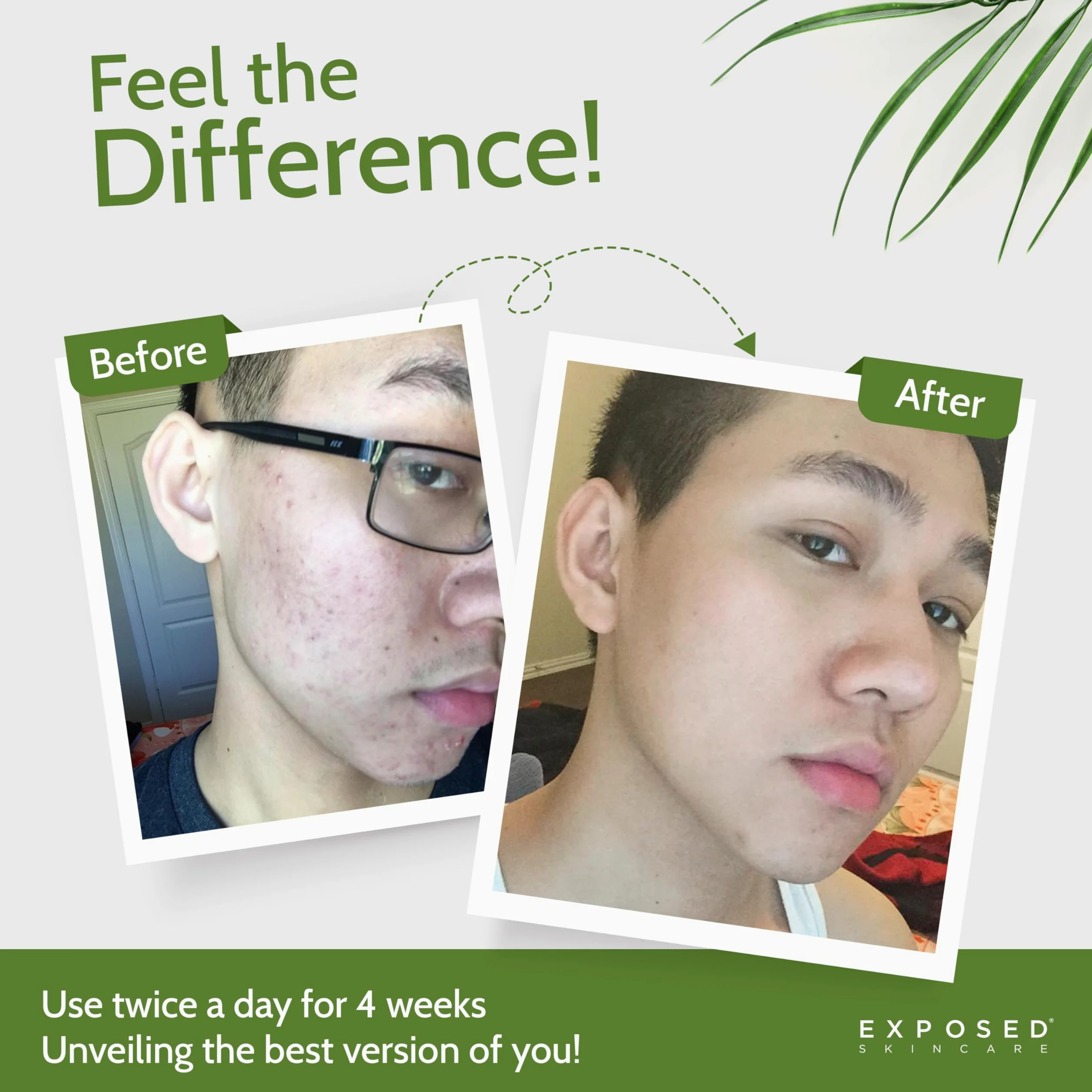 Exposed Skin Care Kit de tratamiento para el acné - Solución natural para el acné para el rostro, todos los tipos de piel y edades - Contiene detergente, tónico, suero, suero limpiador de poros