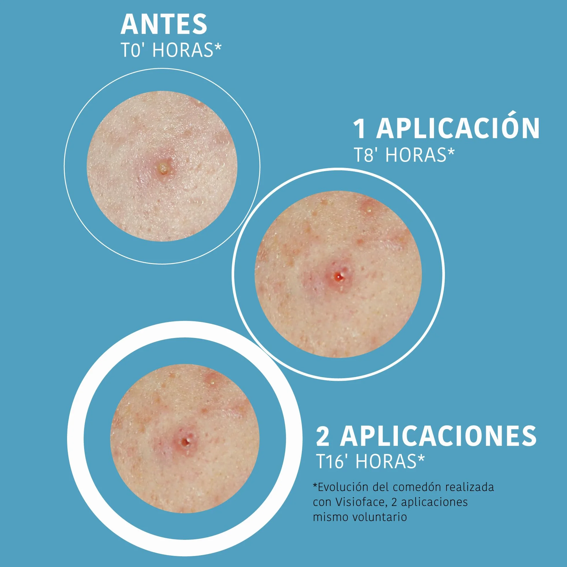 Parches para Granos con Ácido Salicílico, Árbol de Té y Centella Asiática, 18 unidades