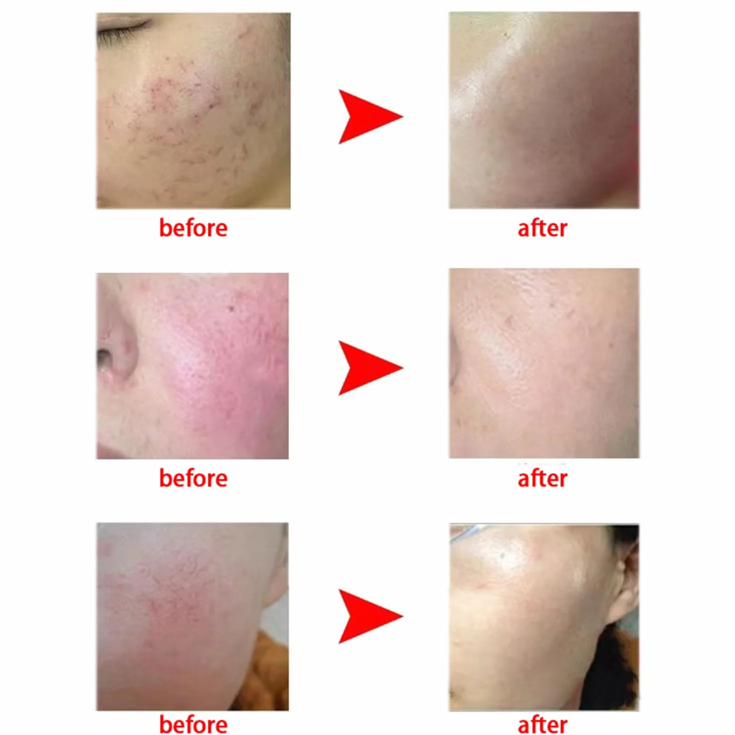 Dispositivo de eliminación de arañas vasculares de Alta frecuencia, máquina de Belleza para Eliminar Venas de Hilo Facial, Manchas de Vasos sanguíneos Rojos, para piernas, Cara, Nariz, para Mujeres