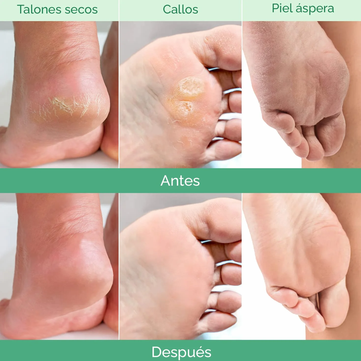 PLANTIFIQUE Calcetines Exfoliantes de Pies 4 Combo Pack Mascarillas Peeling Callos Eliminar Pedicura Profesional