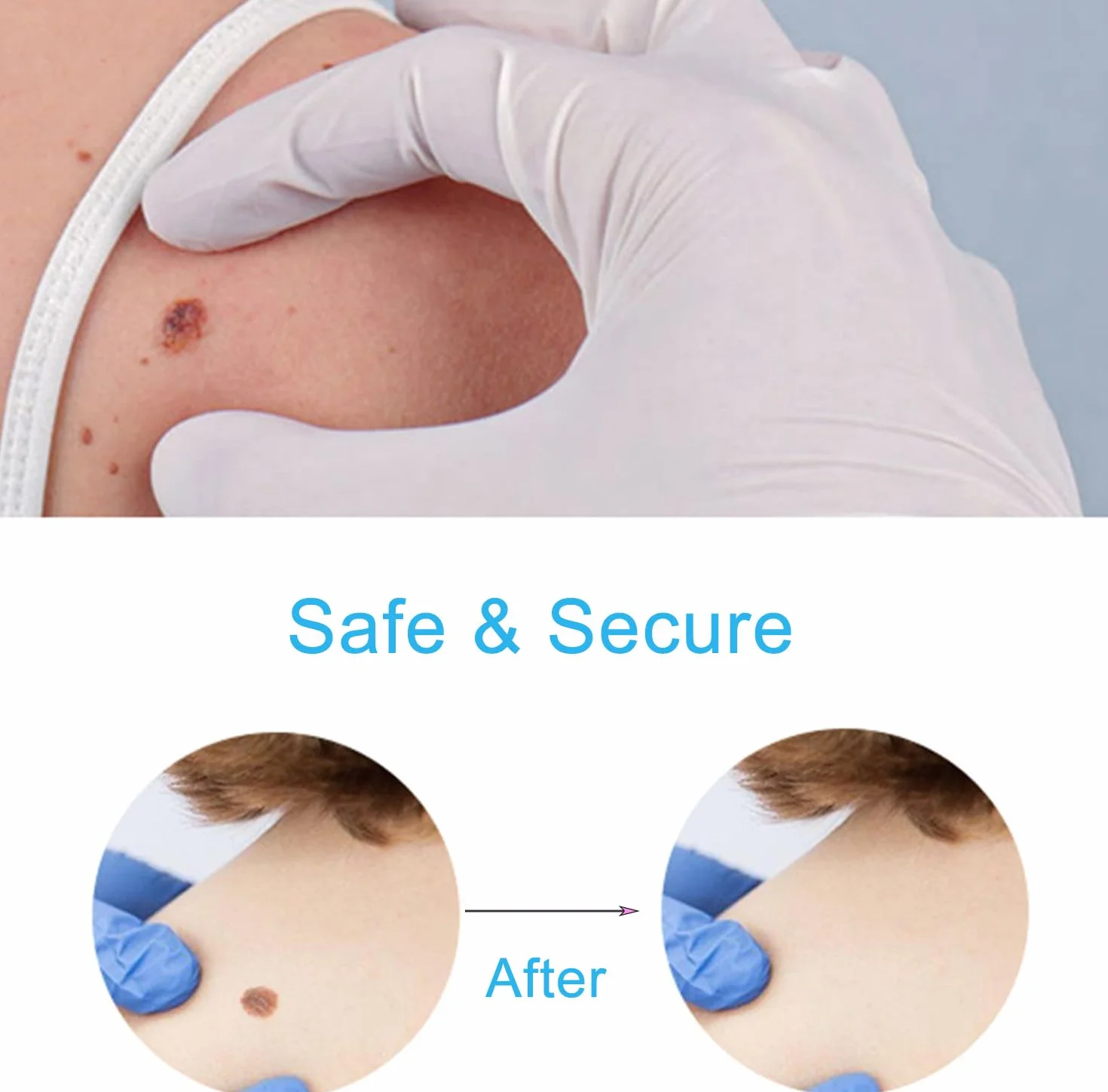 Lápiz removedor de verrugas, Elimina verrugas en pies, manos, brazos, piernas y cuerpo, apto para todo tipo de piel
