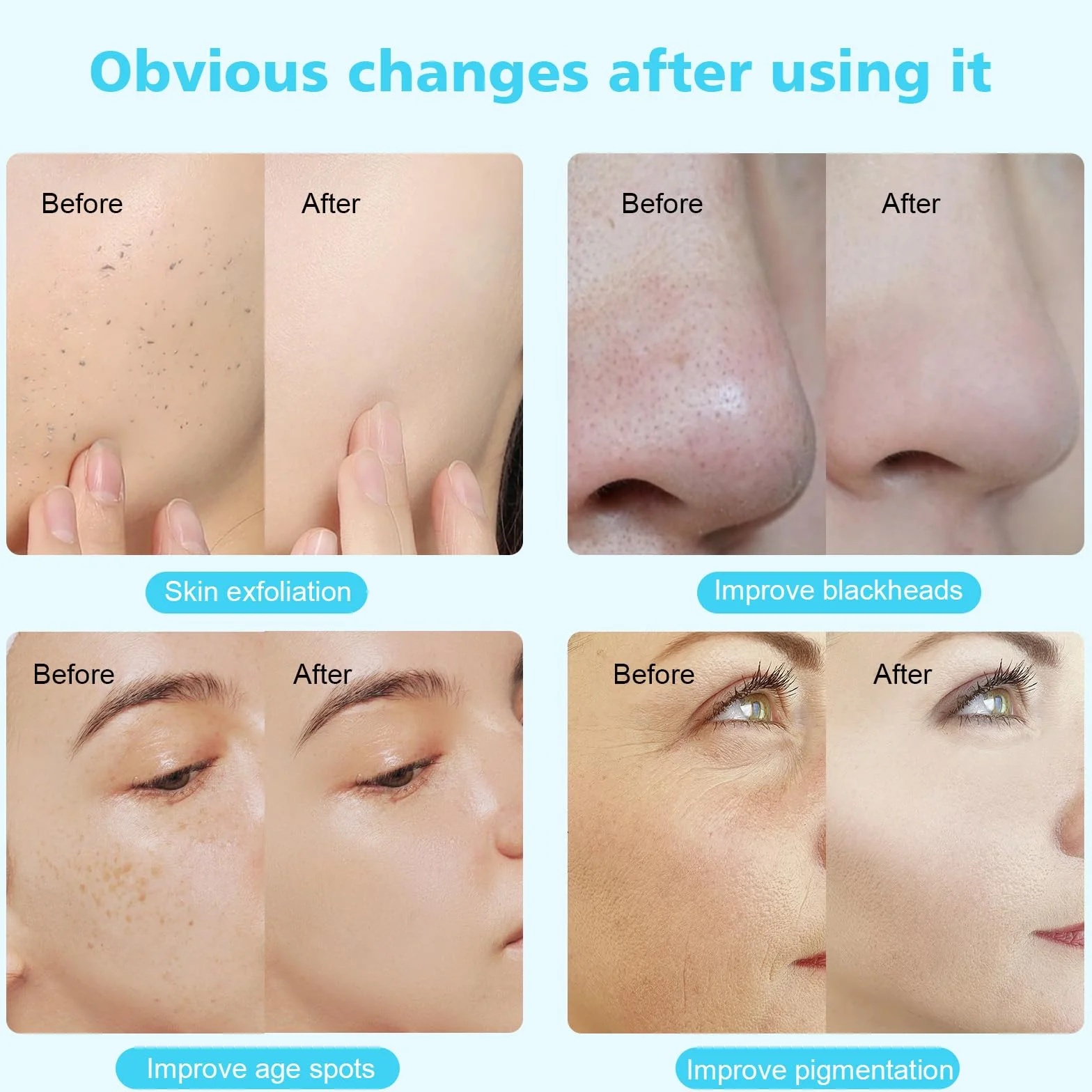 Dispositivo Profesional de Dermoabrasión 3 en 1, Barra Mágica para Salones de Belleza