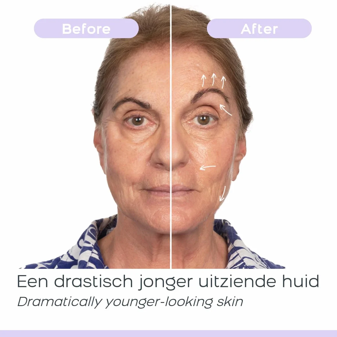 DermaWand Pro - Dispositivo Antienvejecimiento Alta Frecuencia, Reduce Arrugas y Líneas Finas, Reafirma y Revitaliza la Piel Facial, Tratamiento Seguro en Casa