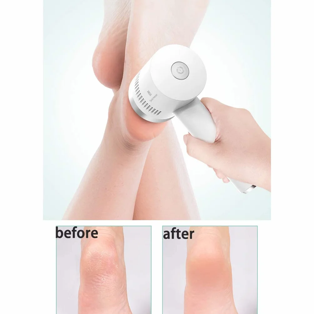 Removedor de callos eléctrico para pies con aspiradora, lima de pies profesional para piel muerta, molinillo de pies recargable por USB, herramientas de pedicura para piel seca y agrietada, C (D)
