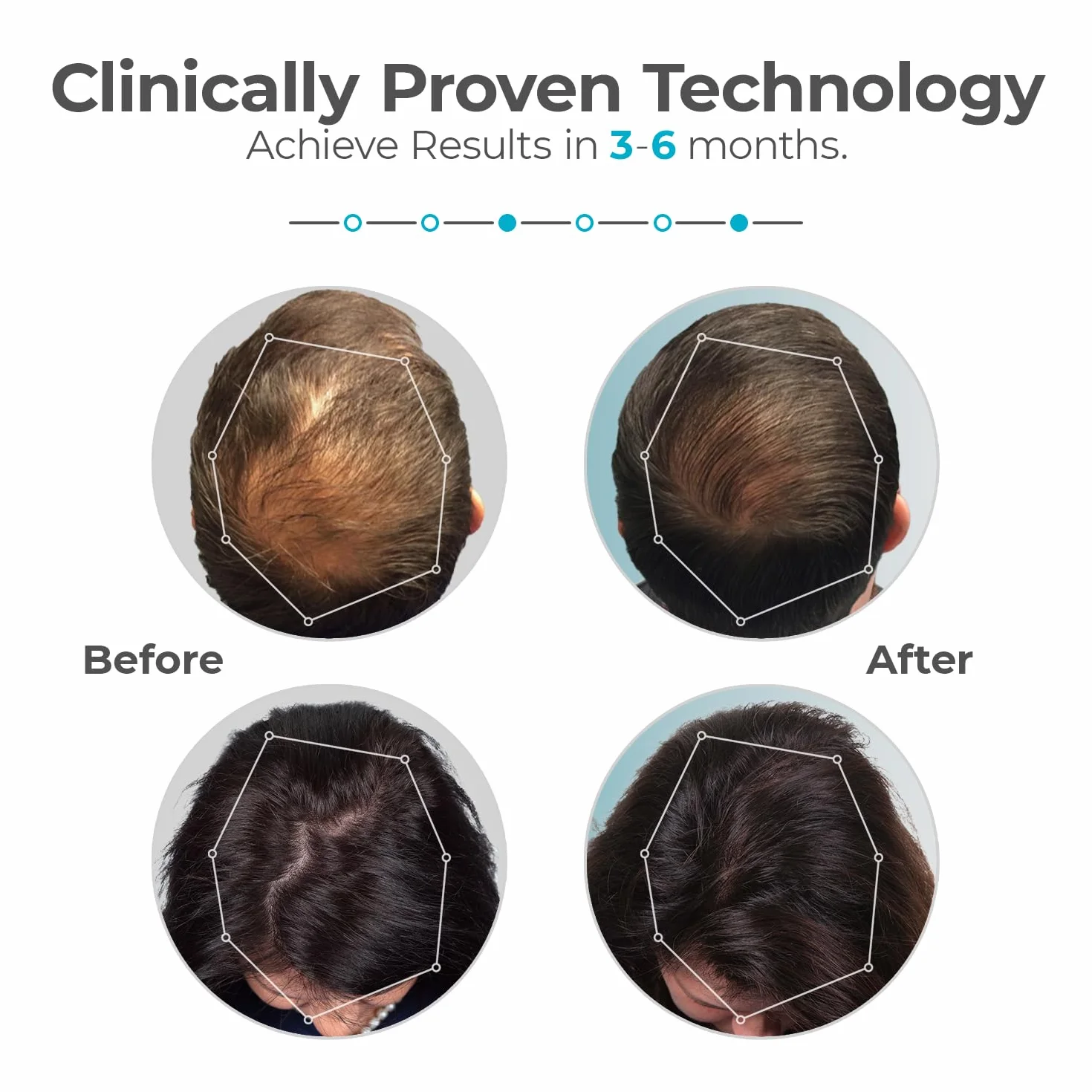 Capillus202 Terapia láser para el crecimiento del pelo – NUEVO Modelo 6 Minutos y Ajuste Flexible. Autorizado por la FDA para Tratamiento Médico de la Alopecia Androgenética – Gran Covertura