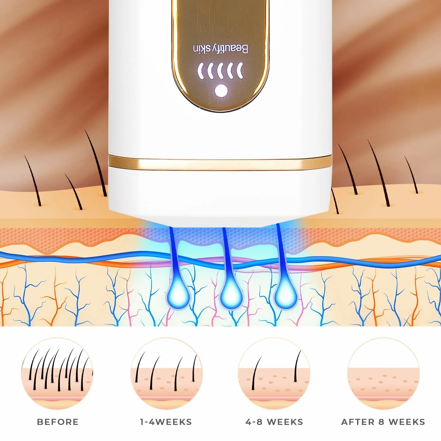 Edicare Depiladora Laser IPL Luz Pulsada, 4 Modos 5 Intensidades, Mujer Hombre Cuerpo