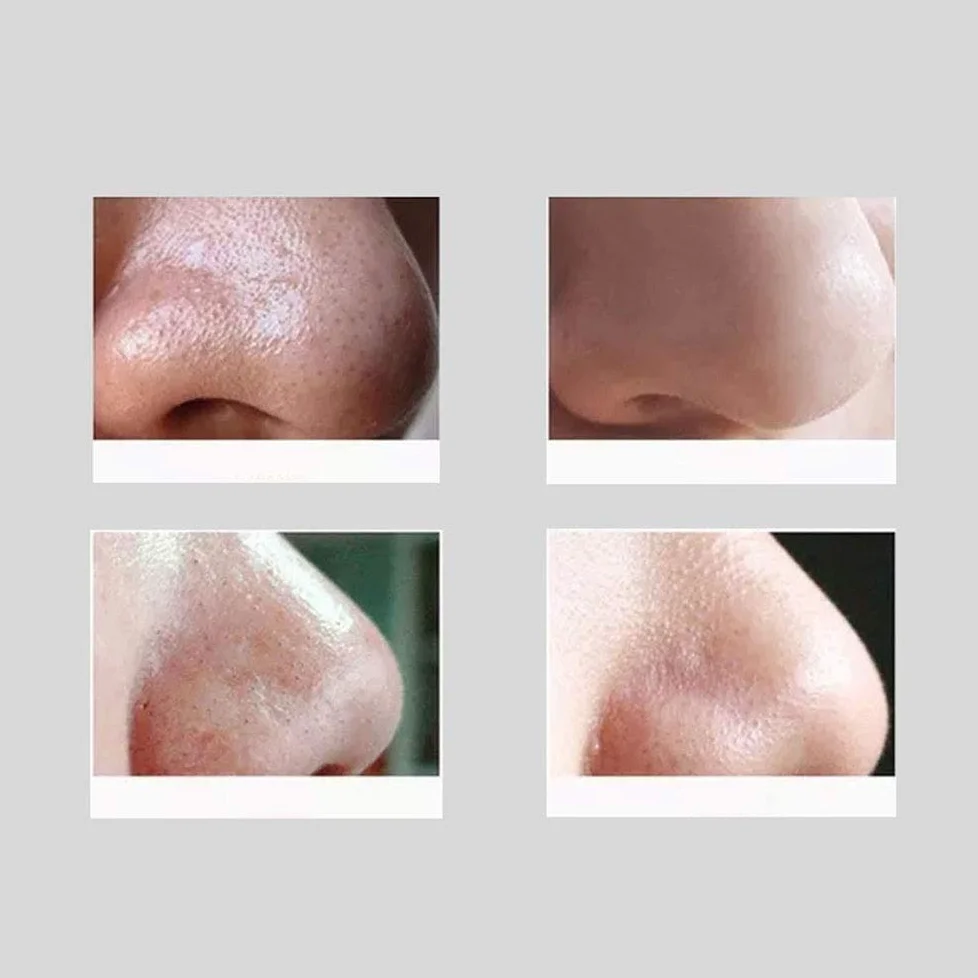 Removedor Blackhead Vacuum Electric BlackheadRemoval Herramientas de Limpiador de Poros Limpiador Facial Limpiador Facial SuctionTools con LED, 7Probóviles de reemplazo, USB Recargable