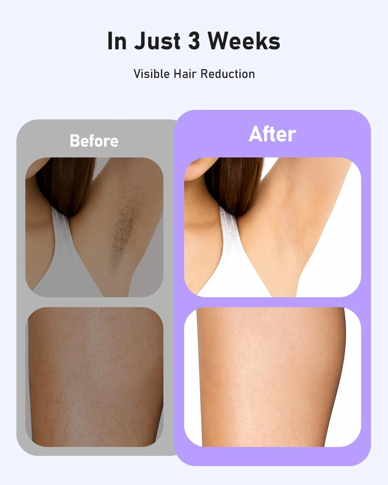 Depiladora Láser IPL Sin Dolor 22J Luz Pulsada IGBT para Cuerpo, Zona Bikini y Piel Sensible