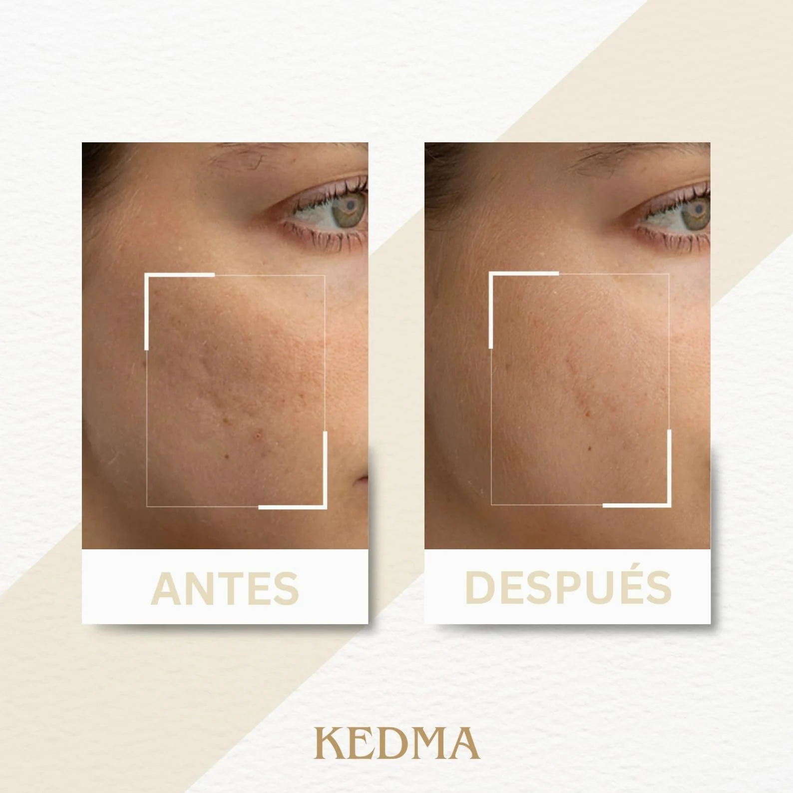 KEDMA - Mascarilla Facial Iluminadora para Piel Apagada & Manchas - 50ml | La mascarilla con caolín, ácidos de frutas y vitamina C purifica y ayuda a iluminar la piel apagada.