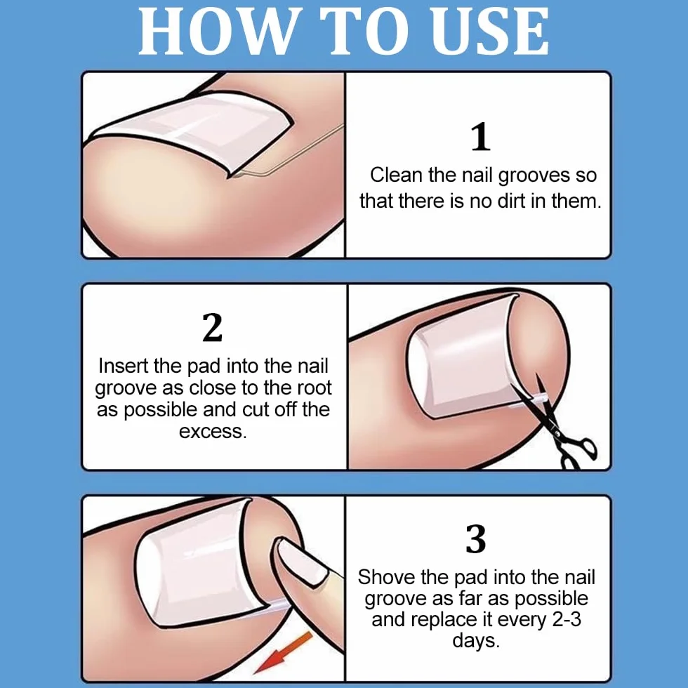 Juego de Corrector de Uñas Encarnadas 50 PCS Tiras Enderezadoras sin Dolor con Elevador de Uñas del Pie