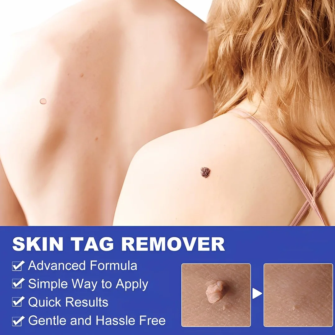Skin Tag Remover Set para Eliminar Verrugas y Lunares Eficaz e Indoloro