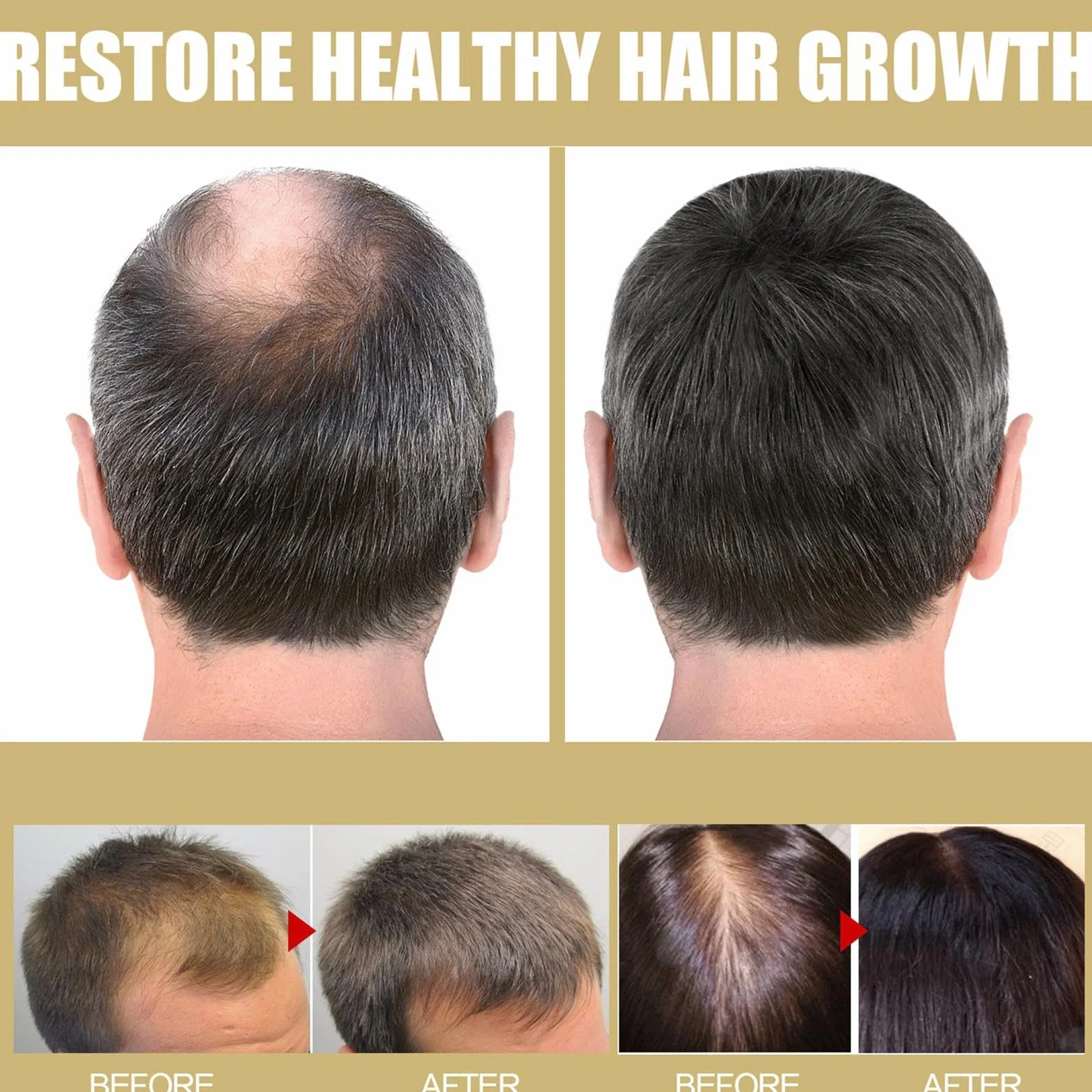 Gorra LED infrarrojo para crecimiento del cabello, dispositivo antialopecia recargable