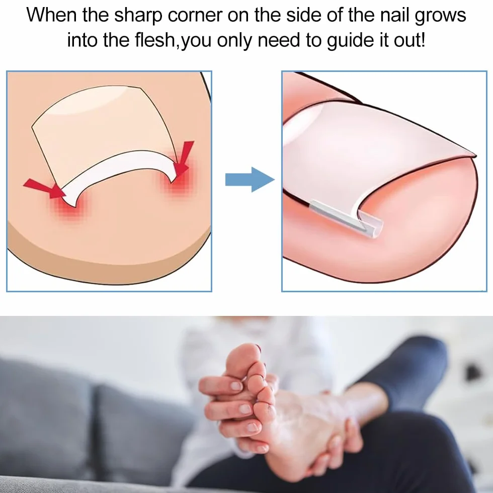 Juego de Corrector de Uñas Encarnadas 50 PCS Tiras Enderezadoras sin Dolor con Elevador de Uñas del Pie