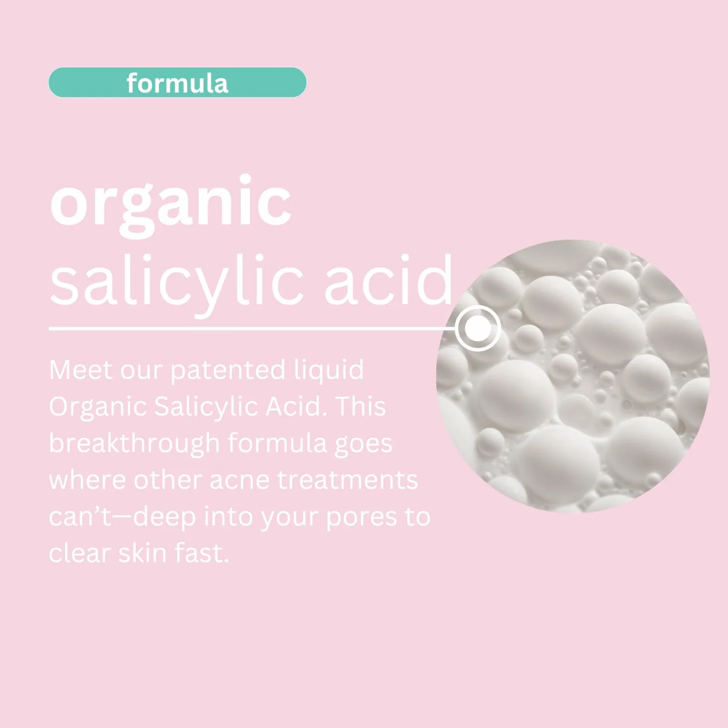 Crema Antiacné PREMIADA - ¡4X MÁS POTENTE y 11X MÁS RÁPIDA! Tecnología patentada con Ácido Salicílico Orgánico, Avellano de Bruja, Vitamina A, Aceite de Árbol de Té y Aloe Vera. Combate Granos - 100ml