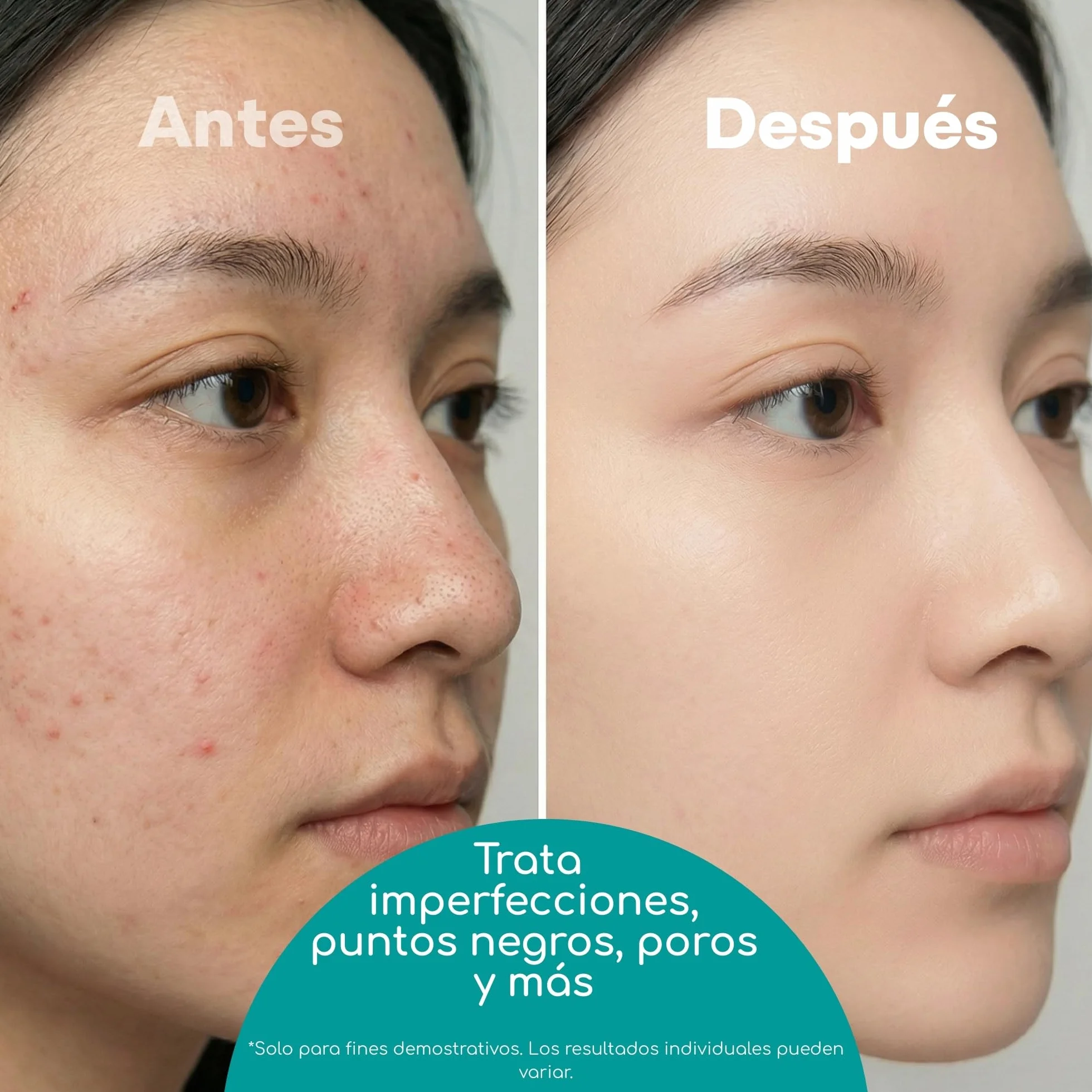 Kit removedor de espinillas y comedón, 7 piezas limpiador de poros