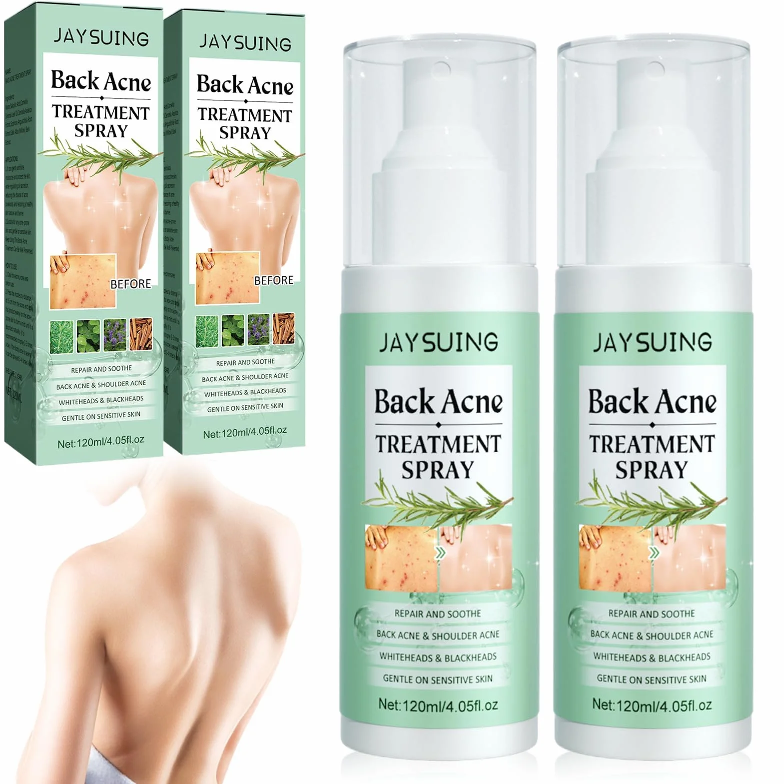 Spray De Tratamiento De Acné 2 PCS, Spray reparador del acné de espalda, Crema Acne Pecho y Espalda