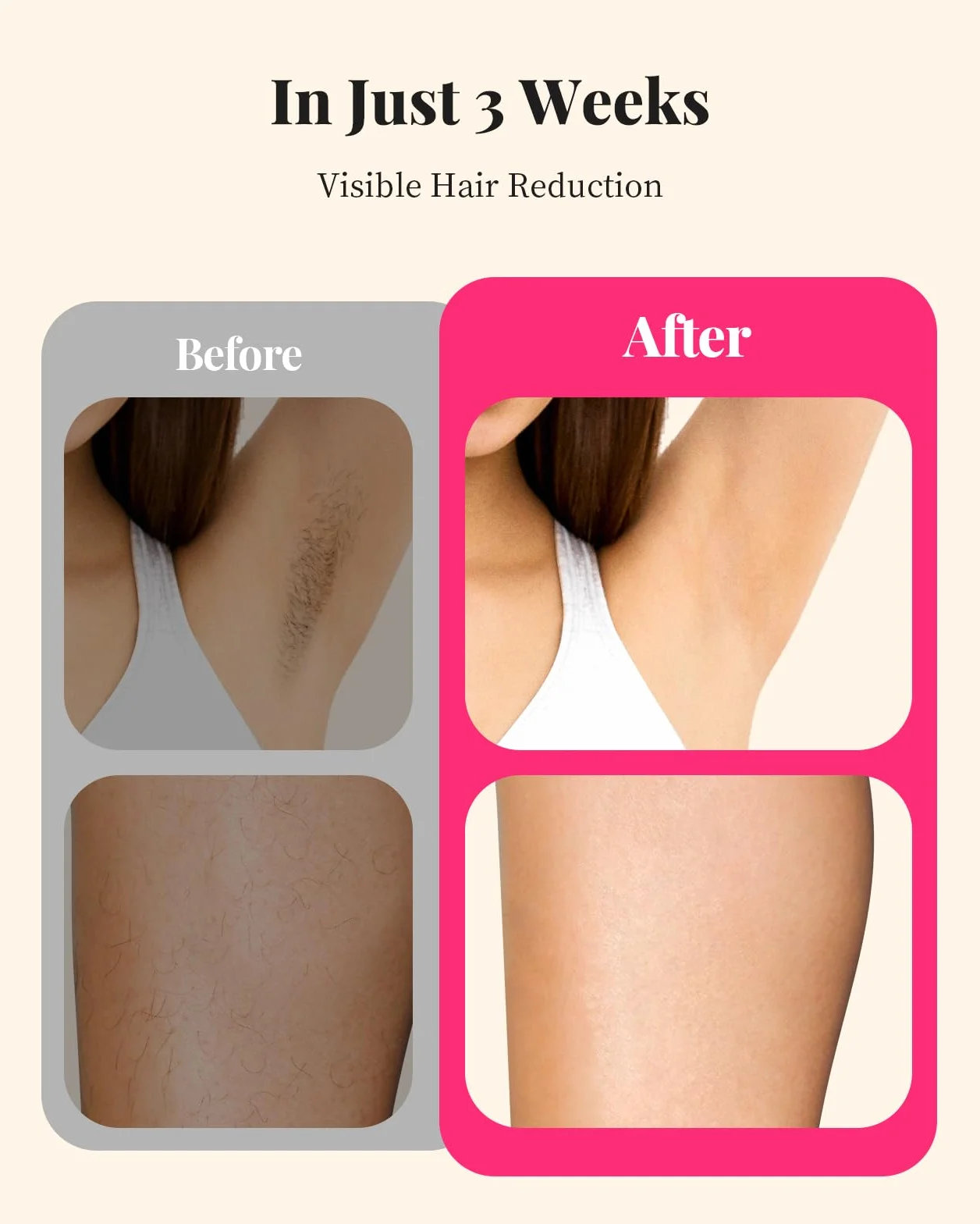 Haarlosy Depiladora de Luz Pulsada IGBT 3 EN 1 HR/SR/HR 9 Niveles de Energía Ajustable OPI01