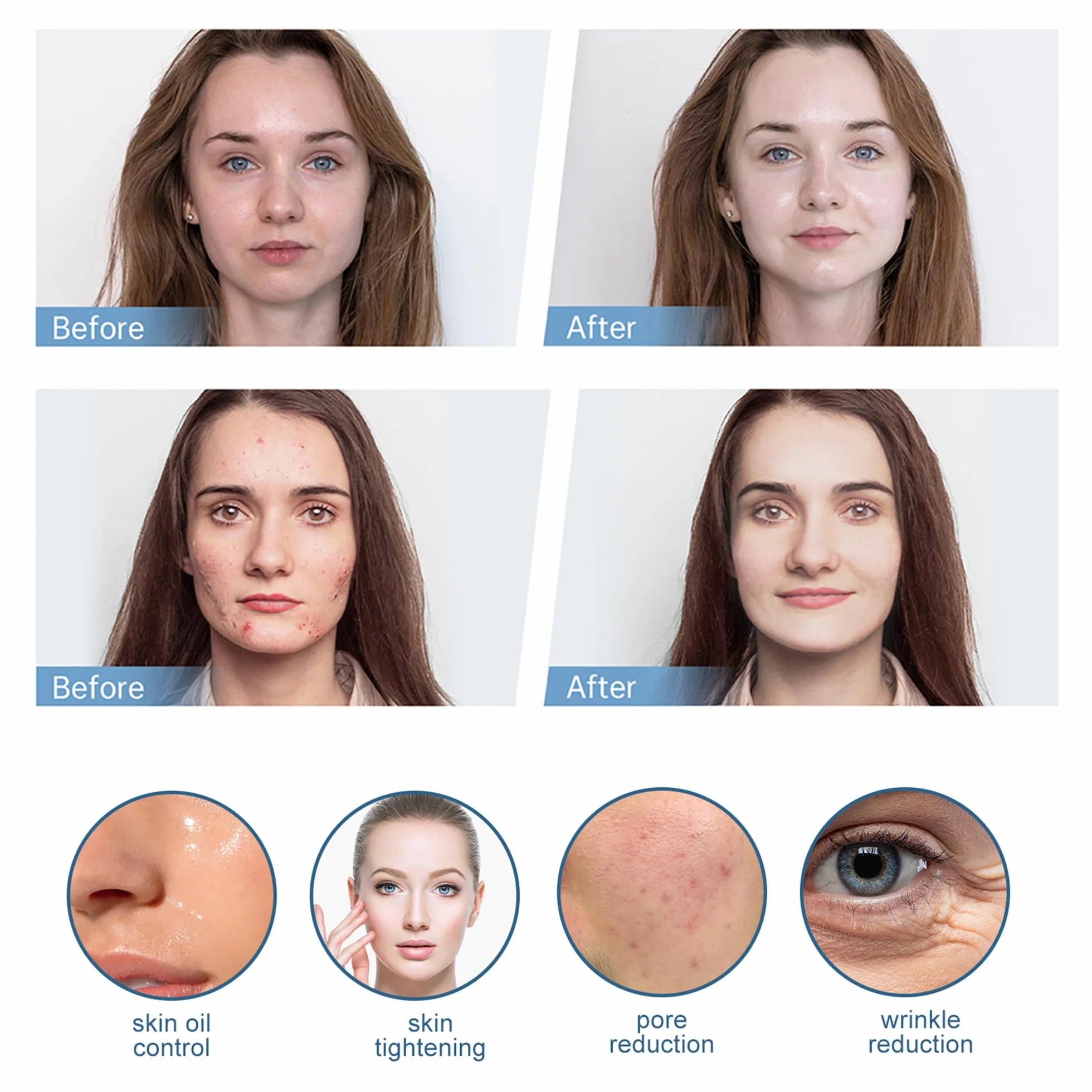 Cartuchos de Repuesto 24 Agujas para Microneedling Compatibles con Hydra Pen H3 H5, 15 Piezas