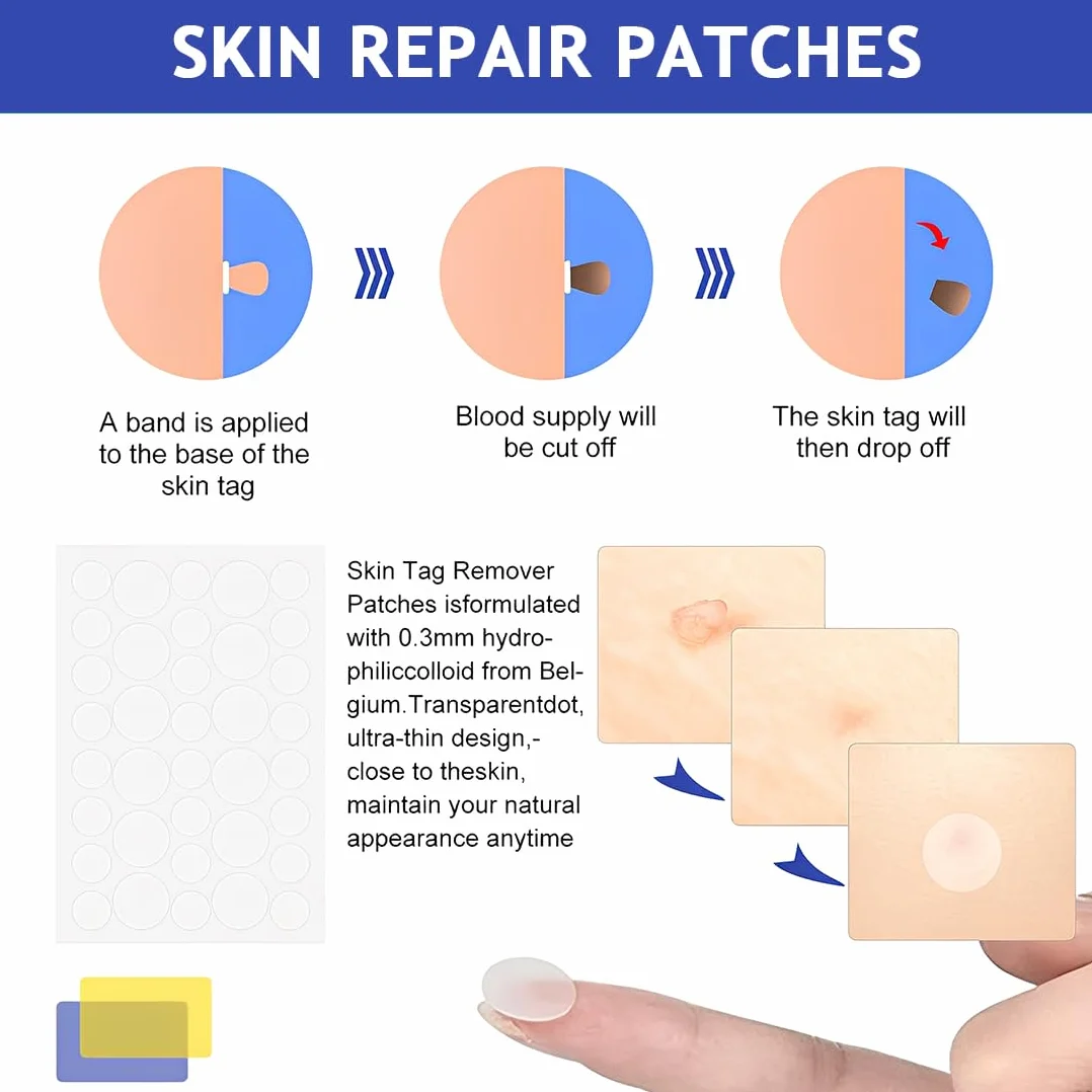 Skin Tag Remover Set para Eliminar Verrugas y Lunares Eficaz e Indoloro
