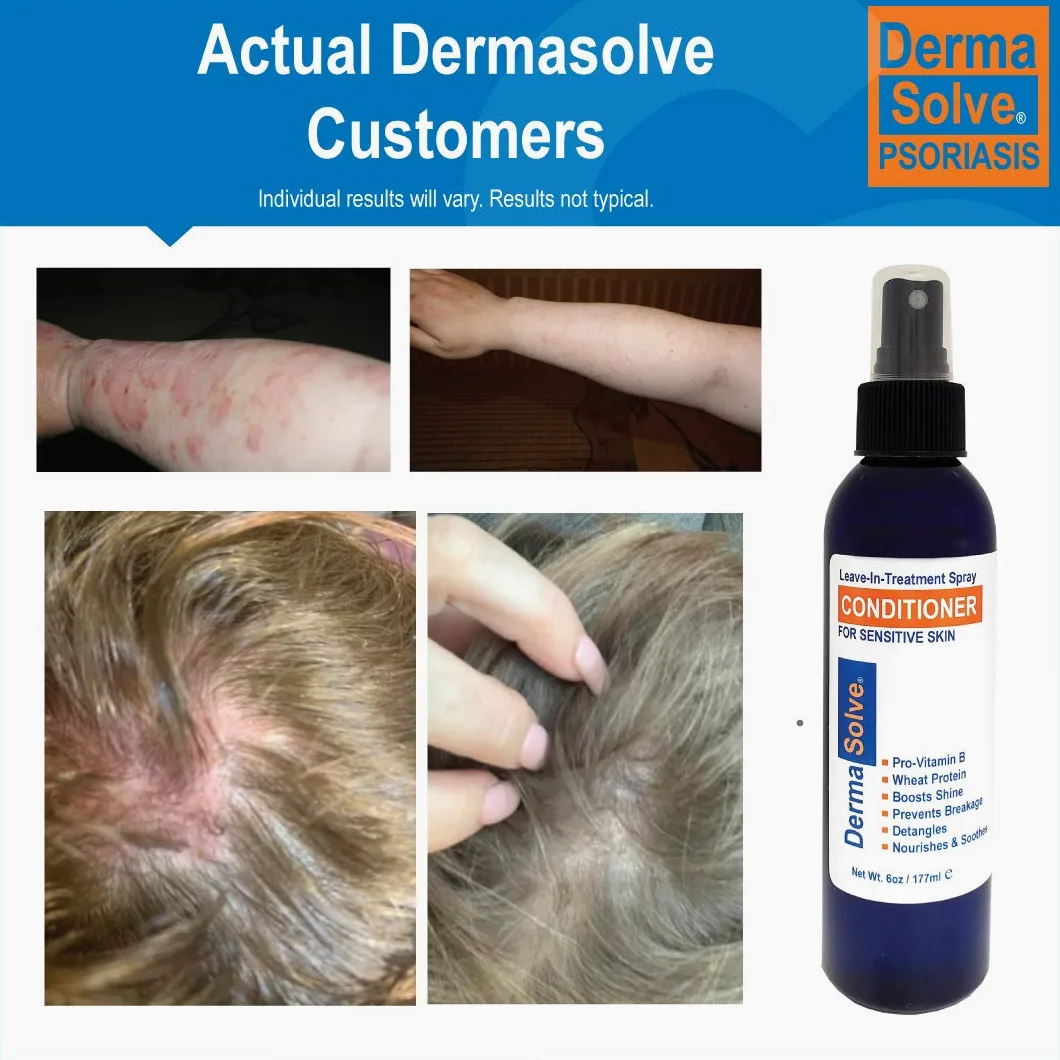 Dermasolve Psoriasis Leave-In-Treatment & Styling Spray Bálsamo para Dermatitis Seborreica, Piel Sensible, Desenredante, Desenredar, Calmante Anticaspa, Reparación del cuero cabelludo seco