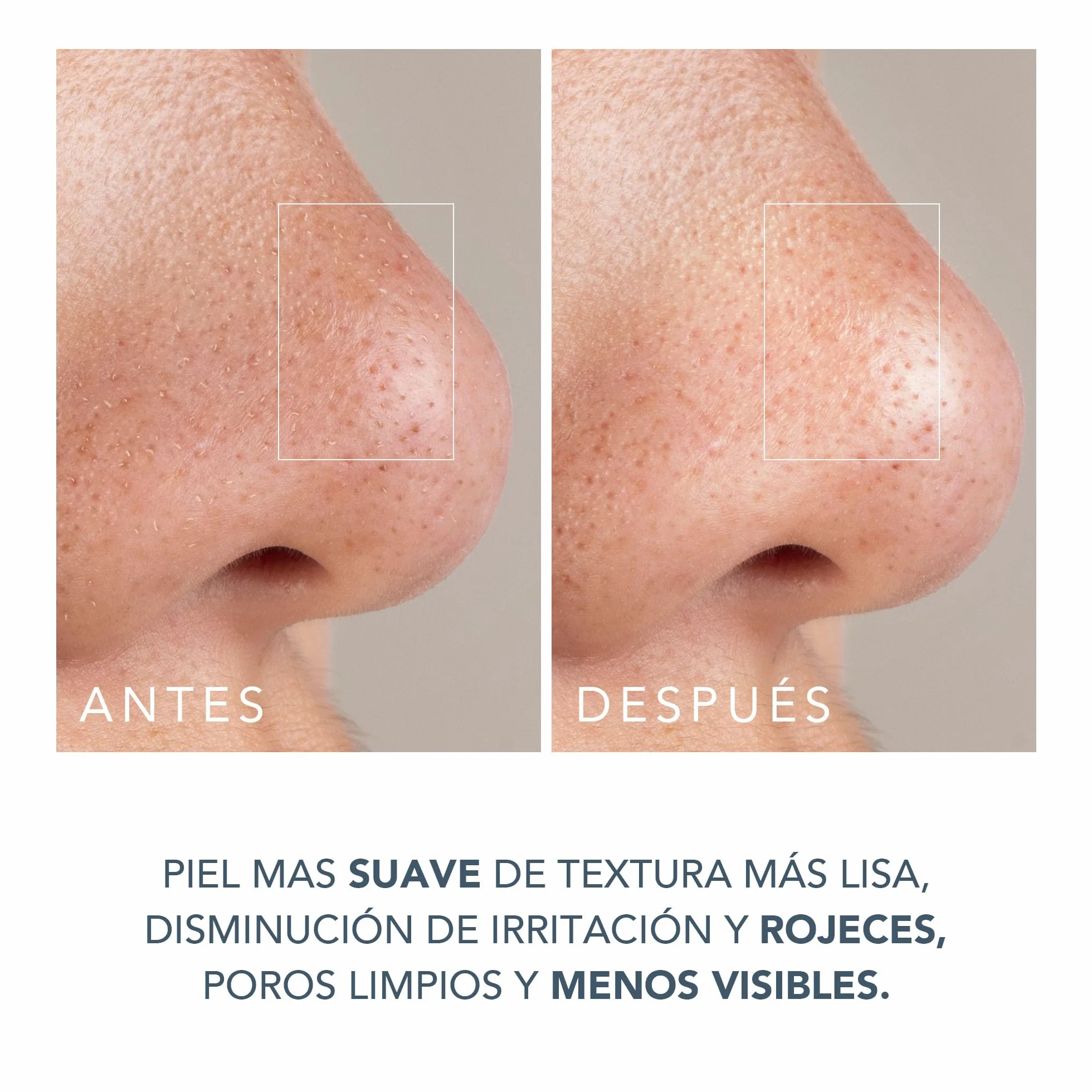 FOREO KIWI Derma Dispositivo de Microdermoabrasión Succionador Extractor Puntos Negros Mascarilla Activa Poros 100g